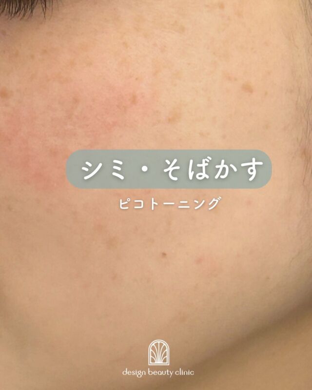 📸
【ピコトーニング症例写真✨】
⁡
本日は、当院でピコトーニングを5回、10回と受けられたお客様の症例をご紹介いたします💁‍♀️
⁡
お写真をご覧いただくと、シミやソバカスが回数を重ねるごとにしっかり薄くなっているのがお分かりいただけるかと思います😊
⁡
ピコトーニングは、お肌へのダメージを最小限に抑えながら、メラニン色素にアプローチできる人気のレーザー治療です✨
⁡
✔ なんとなく顔全体のくすみが気になる
✔ シミやソバカスを薄くしたい
✔ 肌にハリや透明感が欲しい

こんなお悩みをお持ちの方におすすめです🌿
⁡
回数を重ねることで、より高い効果が期待できますので、ぜひ一度ご相談ください😊
⁡

☆初回価格：9,800円
☆通常価格：15,800円

・カウンセリング+施術時間：約1時間
・施術中の痛み：ゴムで弾かれたような体感
（※個人差あり。）
・ダウンタイム：ほぼ無し
（※個人差あり。稀に膨隆疹、赤み、乾燥）
・施術後のメイク：即可能
・効果：肝斑改善、しみ、くすみ、
肌のハリ改善、毛穴の開き改善

————————————

ACCESS：大阪府大阪市北区茶屋町15-8
茶屋町ビル2階
TEL：06-6743-4652
営業時間：10時〜17時
(最終受付時間：16時)
お問合せ受付時間：10時〜19時

⚠️DMでのお問い合わせはお受けしておりません
お問い合わせは、クリニックへ直接お電話をお願いいたします🌱

#美容皮膚科 #美容外科 #美容クリニック #美肌 #女医 #美白 #アンチエイジング #シミ取り #レーザートーニング #肌質改善 #しみ #ハイフ #ウルトラセルQプラス #ルメッカ #フォトフェイシャル
