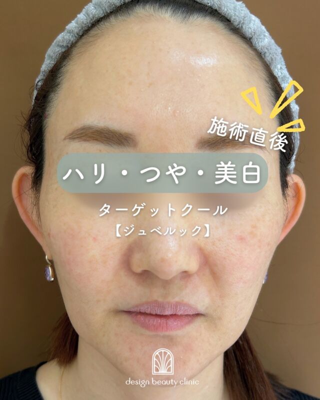 📸
【✨ターゲットクール施術直後✨】
⁡
本日は、女性の患者様のターゲットクール施術直後の症例をご紹介します😊
⁡
📸写真をご覧いただくと、施術直後から赤みなどなくダウンタイムがほとんどない事がお分かりいただけます✨
⁡
✔️ ダウンタイムほぼなし
✔️ 痛みも最小限
✔️ お仕事の合間やご予定の前にも受けやすい
⁡
ターゲットクールは、肌の代謝を整え、毛穴の引き締めや透明感アップにも効果的。
⁡
初めての方も安心して受けていただける施術ですので、ぜひお気軽にご相談くださいね😊
⁡

ターゲットクール🔫
キャンペーン価格✨

🉐【美白】平日11,000円(税込)🉐
2025年9月30日まで

【美白】
初回16,500円
通常22,000円
3回コース49,500円

追加オプション
ボツラックス 9,800円

【ジュベルック】
初回32,000円
通常41,000円
3回コース96,000円

追加オプション
ボツラックス 9,800円

【ボツラックス】
通常 22,000円
⚠️初回、コースのご用意はございません。

※価格は全て税込です

ターゲットクールは、
冷却と同時に美容成分を
肌の奥まで届ける最新肌育治療✨

毛穴の引き締め、ハリ・ツヤUP
小じわケアまで即効アプローチ👌
施術時間は約15分、
ダウンタイムほぼなしで当日メイクOK。

こんな方におすすめ
✔ 痛みが苦手で肌育治療を諦めていた方
✔ ダウンタイムなしで即効性がほしい方
✔ 注射や針が苦手な方
✔ イベントや旅行前に肌を整えたい方

💠新感覚のひんやり美肌ケア、ぜひお試しください

⚠️DMでのお問い合わせはお受けしておりません。
お問い合わせは、クリニックへ直接お電話をお願いいたします🌱

————————————

ACCESS：大阪府大阪市北区茶屋町15-8
茶屋町ビル2階
TEL：06-6743-4652
営業時間：10時〜17時（最終受付16時）
お問合せ受付時間：10時〜19時

#美容皮膚科 #デザインビューティークリニック #ターゲットクール #ジュベルック #トラネキサム酸#美白#メンズ美容