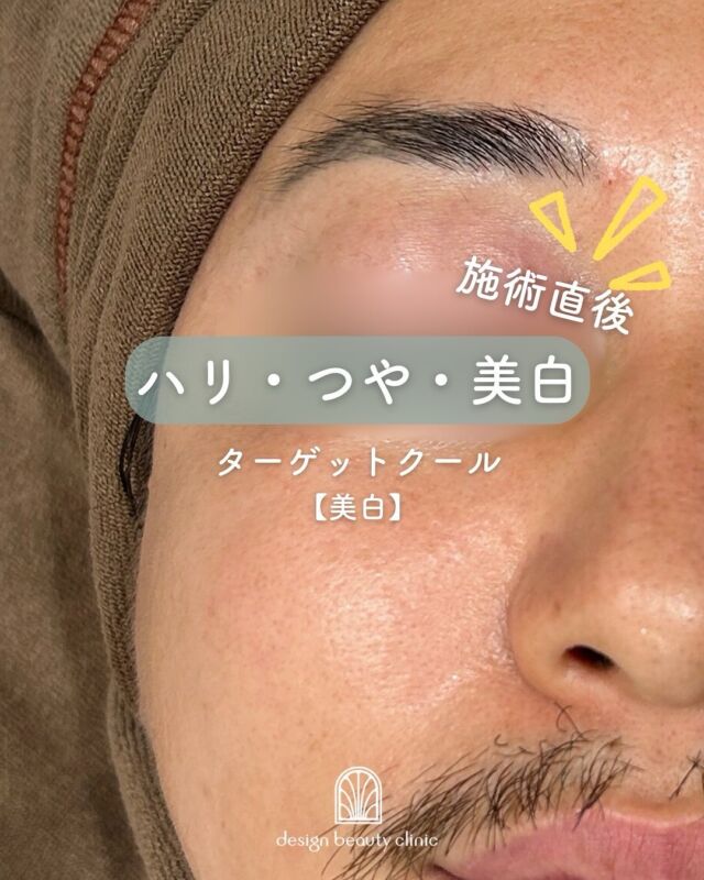 男性にもおすすめ！クール施術のビフォーアフター

こちらは、【クール施術直後】の症例写真です📸
施術直後から肌のハリ・ツヤがはっきりとわかる仕上がりに✨
毛穴もキュッと引き締まり、清潔感ある若々しい印象に整いました。

男性は皮脂量が多く、毛穴やテカリに悩まれる方も多いですが、
クール系施術はそんなお悩みにピッタリ！
肌をクールダウンしながら必要な美容成分を届けることで、
赤みや炎症も抑えつつ、透明感のある健康的な肌へ導きます💆‍♂️

💡男性におすすめの理由
✔︎ ダウンタイムほぼなし
✔︎ 施術時間が短く、仕事帰りにもOK
✔︎ 清潔感UPで第一印象が変わる
✔︎ ナチュラルに若々しく見せたい方に◎

「肌、何かしてる？」と聞かれる自然な変化を体感しませんか？

ターゲットクール🔫
キャンペーン価格✨

🉐【美白】平日11,000円(税込)🉐
2025年9月30日まで

【美白】
初回16,500円
通常22,000円
3回コース49,500円

追加オプション
ボツラックス 9,800円

【ジュベルック】
初回32,000円
通常41,000円
3回コース96,000円

追加オプション
ボツラックス 9,800円

【ボツラックス】
通常 22,000円
⚠️初回、コースのご用意はございません。

※価格は全て税込です

ターゲットクールは、
冷却と同時に美容成分を
肌の奥まで届ける最新肌育治療✨

毛穴の引き締め、ハリ・ツヤUP
小じわケアまで即効アプローチ👌
施術時間は約15分、
ダウンタイムほぼなしで当日メイクOK。

こんな方におすすめ
✔ 痛みが苦手で肌育治療を諦めていた方
✔ ダウンタイムなしで即効性がほしい方
✔ 注射や針が苦手な方
✔ イベントや旅行前に肌を整えたい方

💠新感覚のひんやり美肌ケア、ぜひお試しください

⚠️DMでのお問い合わせはお受けしておりません。
お問い合わせは、クリニックへ直接お電話をお願いいたします🌱

————————————

ACCESS：大阪府大阪市北区茶屋町15-8
茶屋町ビル2階
TEL：06-6743-4652
営業時間：10時〜17時（最終受付16時）
お問合せ受付時間：10時〜19時

#美容皮膚科 #デザインビューティークリニック #ターゲットクール #ジュベルック #トラネキサム酸#美白#メンズ美容