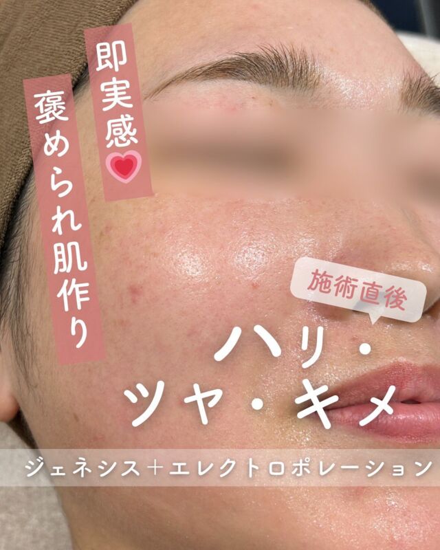 📸
【施術直後から変化を実感✨ジェネシス＋エレクトロポレーション症例】

こちらは、ジェネシスとエレクトロポレーションを組み合わせた施術後の症例写真です📸
施術直後とは思えないほど、毛穴が引き締まり、肌のキメが整って、内側からあふれるようなツヤ肌に仕上がっています💎

🌿《ジェネシス》
お肌の深部をやさしく加温しながら、コラーゲン生成をサポート。毛穴の開きや赤みの改善に効果的！

💧《エレクトロポレーション》
美容成分を肌の奥深くまでしっかり届け、潤いと透明感をプラスしてくれます。

＼この2つを組み合わせることで／
✔ 毛穴の目立ちにくいなめらか肌
✔ ハリと自然なツヤ感アップ
✔ 肌トーンの明るさUP
✔ 乾燥・くすみケアにも◎

施術後には多くの方が、
「お肌がつるんと整った感じがする」
「メイクのりが全然違う！」
と、うれしい変化をすぐに感じられています😊

季節の変わり目や、お肌がゆらぎやすい時期のケア、ちょっと贅沢なご褒美にもぴったりのメニュー✨
気になる方は、お気軽にご相談ください♪
～ジェネシスって何？～
ジェネシスは、１施術で何役もこなす多彩な効果を持つため、いくつかの複合的な肌のお悩みにアプローチ出来ます。
主な効果はこちらになります。
・レーザーピーリング効果により、悪化したニキビやニキビ跡の改善を促し、毛穴の引き締めにも効果的ターンオーバーの乱れを正常な状態に近づける事によって、色素沈着の
改善や、シミのやくすみの改善
・真皮層に位置する微小血管を加熱し、血管壁や赤血球を破壊することによって、赤ら顔や毛細血管拡張症の改善
・真皮層に働きかけることでコラーゲンの生成を促し、ハリのあるきめ細やかな肌を作る

マイルドなレーザーのため、体感としては温かい熱のシャワーを浴びているような感覚で、照射時は痛みがほとんどありません。
☆初回3000shot：7,800円
☆通常3000shot：10,800円
☆初回6000shot：13,600円
☆通常6000shot：18,800円
・カウンセリング＋施術時間： 45分～60分
・施術中の痛み：ほとんどなし
・ダウンタイム： 赤みや熱感、痒み等の肌荒れが生じる場合あり
・施術後のメイク：当日からOK
・効果：赤ら顔、ハリツヤ、ニキビ痕の赤み、ニキビ痕の色素沈着、肌のキメなどの肌質改善

～エレクトロポレーションって何？～
エレクトロポレーションはノーニードルセラピーといわれ、針を使わず美容成分をお肌の奥まで浸透させる新しい導入法です。
皮膚に微弱な電気パルスを加えることで一時的に皮膚の細胞間にすき間を作り、そのすき間から美容成分をお肌の奥まで届けることができます。
乾燥が気になる時やイベント前のケア✨にも大変おすすめです。

お痛みやダウンタウンもなどもありません。
☆初回：5,500円
☆通常：6,600円
・カウンセリング＋施術時間：約60分
・施術中の痛み：電流によるピリピリ感があります。（個人差があります）
・ダウンタイム：なし
・施術後のメイク：当日からOK
・効果：美容成分導入・保湿・鎮静

◾️追加薬剤オプション
各3,300円
⭐︎美白（ビタミンC＋トラネキサム酸）
⭐︎ニキビ（ビタミンC＋ビタミンB）
⭐︎エイジング（ビタミンE＋EMN）

上記オプションに➕550円で、
さらにビタミンCの追加が可能❤️

※全て税込価格

⚠️DMでのお問い合わせはお受けしておりません
お問い合わせは、クリニックへ直接お電話をお願いいたします🌱

-———————————

ACCESS：大阪府大阪市北区茶屋町15-8
茶屋町ビル2階
TEL：06-6743-4652
営業時間：10時〜17時
(最終受付時間：16時)
お問合せ受付時間：10時〜19時

#美容皮膚科 #美容外科 #美容クリニック #美肌 #女医 #ニキビ跡 #ニキビ痕 #保湿 #エイジングケア #肌質改善#ジェネシス#エレクトロポレーション