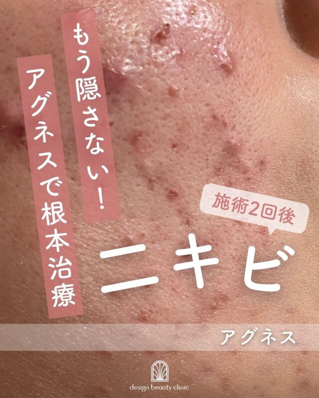 🌿
【アグネス施術症例📸 Before → 2回施術後（2ヶ月後）】

アグネス施術を2回受けられた患者さまの症例写真をご紹介します✨
施術前と比べると、炎症がしっかりとおさまり、赤みや膿を伴うニキビが落ち着いているのがよく分かります☺️

＼ニキビが落ち着いた後は…✨／
次のステップとして、【ニキビ跡・毛穴の治療】がおすすめ！
肌のターンオーバーを促進し、色素沈着や凹凸の改善を目指する治療を提案します💆‍♀️

🔍アグネスはこんな方におすすめ！
・何度も同じ場所にニキビができてしまう
・痛みや赤みを伴うニキビがなかなか引かない
・皮膚科や市販薬では改善が難しかった
・ニキビ痕を残したくない方

アグネスって何？
アグネスは、選択的に皮脂腺を破壊することで、
ニキビの原因を根本から治療する本質的なニキビ治療治療です。
「毛根を破壊して脱毛ができる」のと同様に、
破壊された皮脂腺は再生せず、長期的なニキビ予防効果が期待できます💥

当院では施術前にしっかりとカウンセリングを行い、
生活習慣やスキンケアの見直しもサポート✨
肌に合った基礎化粧品やインナーケアもご提案しています♪

🗓1回の施術でも効果を実感される方が多く、数回の施術で肌質そのものが変わってきた！という嬉しいお声も✨

また、ジェネシス（ニキビ痕・赤みケア）治療と併用することで相乗効果が高まります🌟

【料金案内】
アグネス
☆全顔初回：39,800円
☆全顔通常：59,800円
☆部分初回：10,800円
☆部分通常：16,500円
※麻酔代別途：3,000円
※汗管腫の施術は上記とは異なる料金設定です

・カウンセリング＋施術時間：約1時間
・施術中の痛み：表面麻酔を使用します
・ダウンタイム：1週間前後、赤み・腫れ・熱感が生じる場合あり（個人差あり）
・施術後のメイク：術後3日以降から可能
・効果：ニキビ、汗管腫への改善

⚠️DMでのお問い合わせはお受けしておりません。
お問い合わせは、クリニックへ直接お電話をお願いいたします🌱

————————————

ACCESS：大阪府大阪市北区茶屋町15-8
茶屋町ビル2階
TEL：06-6743-4652
営業時間：10時〜17時（最終受付16時）
お問合せ受付時間：10時〜19時

#アグネス #ニキビ治療 #繰り返すニキビ #口周りニキビ #皮...