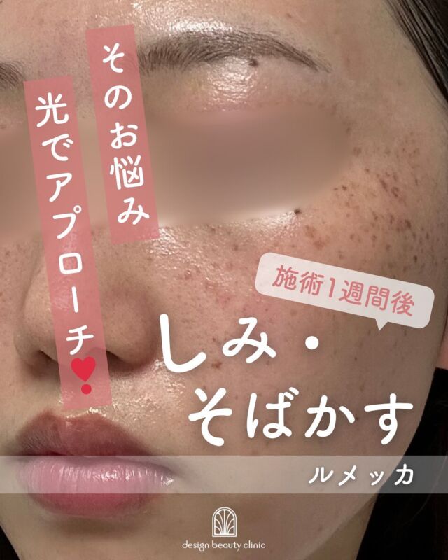 📸
【ルメッカ症例写真のご紹介】
今回は、ルメッカ施術の経過をご紹介いたします✨

写真は、
🔹施術直後
🔹3日後
🔹1週間後
の順に並んでいます。

施術直後は、一時的にシミやそばかすが濃く反応することがありますが、これは正常な反応です😊
数日かけて少しずつ薄くなり、1週間後には明るく透明感のあるお肌に✨

1回の施術でもこのようにしっかりと効果が現れるのがルメッカの魅力です🌿

気になるお肌のくすみやシミにお悩みの方は、ぜひ一度ご相談ください💬
お一人おひとりに合わせたご提案をさせていただきます😊

💡こんな方におすすめ
・そばかすやシミを薄くしたい
・お肌のトーンアップをしたい
・ノーファンデ肌を目指したい

📌治療効果の現れ方には個人差があります。
お肌の状態やしみの種類・深さなどにより、必要な回数やケア方法は異なります。
まずは丁寧なカウンセリングで、お悩みをしっかりお伺いさせていただきますのでご安心ください。

～ルメッカって何？～
ルメッカは従来のIPLに比べて高出力・高反応の光治療。
シミ・そばかす・赤ら顔などの色ムラにアプローチしながら、
コラーゲン生成を促進し、肌のハリ・透明感も高めることができる美肌治療です🌿

治療直後は反応したシミが濃く浮き出ることもありますが、
約1週間程度で薄いかさぶたのように自然に剥がれ、1ヶ月かけてなめらかな肌に整っていきます。

【料金案内】
☆全顔初回：12,800円
☆全顔通常：20,000円
☆手の甲初回：12,800円
☆手の甲通常：20,000円

・カウンセリング＋施術時間：約1時間
・施術中の痛み：個人差はありますが、我慢できる程度です
・ダウンタイム：2～3日～1週間程度、赤みやひりつきが生じる場合あり（個人差あり）
・施術後のメイク：当日からOK
・効果：シミ・そばかす・赤ら顔の改善、肌のハリ・潤いアップ

シミが出来る原因としては様々な要因が考えられるため、
治療後もシミが増えない肌作りをしていくために、
日頃の生活習慣の改善やスキンケアの見直しは必須となります。
インナーケアの手助けになるサプリメント、スキンケアも数多く
取り扱っておりますので、お気軽にご相談ください。

⚠️DMでのお問い合わせはお受けしておりません。
お問い合わせは、クリニックへ直接お電話をお願いいたします🌱

————————————

ACCESS：大阪府大阪市北区茶屋町15-8
茶屋町ビル2階
TEL：06-6743-4652
営業時間：10時〜17時（最終受付16時）
お問合せ受付時間：10時〜19時

#ルメッカ #LUMECCA #光治療 #しみ治療 #シミ改善 #肌トーンアップ #フォトフェイシャル #美肌ケア #症例紹介#IPL光治療 #シミ治療 #そばかす改善 #赤ら顔治療 #肌質改善 #美白ケア #トーンアップ #美容皮膚科 #デザインビューティークリニック