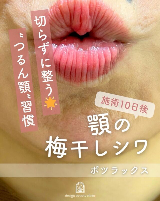 📸
【症例写真：顎ボツラックス 施術前〜10日後】

顎の梅干しジワが気になる方に人気の「ボツラックス（ボトックス）」✨
こちらは、施術前と10日後の比較写真です。

施術後は…
✅ 気になっていたシワがなめらかに
✅ 顎のラインがスッと整い、シャープな印象に
✅ 全体的に「つるん」とした、清潔感のあるフェイスラインに変化しています✨

顎ボツラックスは、ただシワを抑えるだけでなく、輪郭の美しさを引き出す効果も期待できます😊

ダウンタイムも少なく、ナチュラルな仕上がりを目指したい方におすすめの施術です。

💡 顎ボトックス（ボツラックス）のメリット
✔︎ 表情のクセによる顎のシワを改善
✔︎ 顎先の緊張が緩み、フェイスラインがなめらかに
✔︎ 食いしばり・顎の疲れの軽減にも効果的
✔︎ ダウンタイムがほぼなし、施術は数分で完了
✔︎ 初めてのボトックス施術としても人気◎

🪞 なぜ下顔面がスッキリ見えるの？
顎の筋肉が過剰に緊張していると、顎がギュッと縮こまって見えたり、輪郭がぼやけて見えることも。
ボツラックスで筋肉の緊張を和らげることで、顎先が自然とリラックスした位置に戻り、フェイスラインがすっきり整って見えるようになります✨

ナチュラルに美しい輪郭と表情を手に入れたい方、ぜひご相談ください😊

💉ボツラックスの効果持続期間
個人差はありますが3～4ヶ月程度とされています。
注射を行ってから2〜3日程度で効果があらわれはじめ、徐々にシワや多汗症などが改善されて、1ヶ月かけて身体に馴染んでいきます。

3〜4ヶ月をピークに徐々に効果が薄れていき、治療から6ヶ月経つ頃には効果もなくなっていることがほとんどです。
ボツラックス注射の効果を維持するために、4〜6ヶ月に一回定期的に施術を受けることがお勧めです。

■額or眉間or目尻or目の下or顎
各：6,000円
・カウンセリング+施術時間：30分
・施術中の痛み：チクっとした痛みあり
（※個人差あり）
（※表面麻酔希望の場合：+3,000円）
・ダウンタイム：内出血がでる場合もありますが、徐々に落ち着きます。
ボツラックスは熱に弱い為、薬剤が安定するまでの１週間は血行を促進させるサウナや岩盤浴などは控えてください。
・施術後のメイク：施術部位を避ければ当日から可能
・効果：表情ジワの改善、エラの改善、小顔効果、肩こり改善、多汗症の改善

■ボツラックス
ボツラックス（Botulax）は、韓国のHugel社が製造したA型ボツリヌス毒素を有効成分とする薬剤です。
承認状況：国内未承認
入手経路：PRSS社より入手
国内の承認医薬品などの有無：同一の成分や性能を有する他の国内承認医薬品等はありません
諸外国における安全性等に係る情報：韓国の食品医薬品安全庁（KFDA）

⚠️DMでのお問い合わせはお受けしておりません
お問い合わせは、クリニックへ直接お電話をお願いいたします🌱

————————————

ACCESS：大阪府大阪市北区茶屋町15-8
茶屋町ビル2階
TEL：06-6743-4652
営業時間：10時〜17時
(最終受付時間：16時)
お問合せ受付時間：10時〜19時

#美容皮膚科 #美容外科 #美容クリニック #エイジング #アンチエイジング #シワ #ボツラックス #ボトックス#デザインビューティクリニック