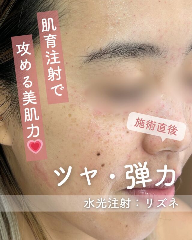 🌟
【水光注射リズネ 施術直後の様子をご紹介】

こちらは「水光注射リズネ」の施術直後のお写真です📷✨

施術後すぐは、写真のように赤みや小さな凸凹感が見られることがありますが、ご安心ください😊
これらの反応は一時的なもので、通常は2～3日ほどで落ち着いてきます。

リズネは、お肌の内側からしっかりと潤いを与え、ハリやツヤ感を引き出す人気の施術です💧✨
数日後には、透明感のあるもっちりとしたお肌の変化を感じていただけるはずです💕

✔ 肌の内側からふっくらとしたハリ感を実感
✔ 自然な仕上がりで美肌に✨
✔ 肌状態に合わせた丁寧な注入が可能💉

～リズネって何？～
リズネは、損傷した肌細胞の再生を促し、ハリ・ツヤ・うるおいを高める“肌育注射”です。
リジュランの後発品として、コストを抑えながらも同等の効果が期待できます✨
『ドクター手打ち』と『ハイコックス（水光注射機器）』、2種類の方法から選択可能です💆‍♀️

～リズネがおすすめな方～
・毛穴の開きや小じわが気になる
・肌のハリや弾力が低下してきた
・凹凸やちりめんじわを改善したい
・お肌の内側からの再生を目指したい

～ハイコックス(水光注射機器)のメリット～
・均一かつスピーディーな薬剤注入が可能
・肌全体をムラなくアプローチ
・施術中の痛み・内出血が出にくく、ダウンタイムも少なめ

当院では韓国で人気の水光注射機器【ハイコックス】を使用✨
薬剤のロスが少なく、痛みも少ないので、初めての方にもおすすめです♪

【リズネ】
リズネは
『ドクター手打ち』と『ハイコックス（水光注射機器）』の
2種類の打ち方からお選びいただけます❣️

■ドクター手打ち（全顔2cc）
通常：57,000円

■ハイコックス（水光注射機器）（全顔2cc）
初回：32,000円
通常：41,000円
3回コース：96,000円

・カウンセリング＋施術時間：約1時間
・施術中の痛み：チクっとした痛み、熱感あり（※表面麻酔使用）
・ダウンタイム：赤み、凹凸感、内出血が2～7日程度出る場合あり

■リズネについて
承認状況：国内未承認
入手経路：ARM社より入手
国内の承認医薬品などの有無：同一の成分や性能を有する他の国内承認医薬品等はありません
諸外国における安全性等に係る情報：韓国の食品医薬品安全庁（KFDA）の承認びCE認証

⚠️DMでのお問い合わせはお受けしておりません。
お問い合わせは、クリニックへ直接お電話をお願いいたします🌱

————————————

ACCESS：大阪府大阪市北区茶屋町15-8
茶屋町ビル2階
TEL：06-6743-4652
営業時間：10時〜17時（最終受付16時）
お問合せ受付時間：10時〜19時

#リズネ #肌育注射 #水光注射 #スキンブースター #ハリ肌 #ツヤ肌 #毛穴改善 #リジュラン #韓国美容 #美容皮膚科 #デザインビューティークリニック