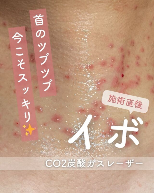 📸
【症例写真ビフォーアフター：首のイボ処置】
こちらは、CO2炭酸ガスレーザーを使用して行った「首のイボ除去」の症例です。
施術直後から4か月後までの経過をご覧いただけます。

✨4か月後には、「何もなかったかのように」お肌がとてもきれいに整っています。
首元は目に入りやすい部位なので、イボがあると気になってしまう…というお声をよくいただきます。

長年お悩みだった方や、
「いつか取りたい」と思いながらもなかなか踏み出せなかった方にも、
ぜひご覧いただきたい症例です。

✔ 目立っていたポツポツがすっきり
✔ 肌の質感がなめらかに
✔ 印象も明るく変化🌟

～CO2炭酸ガスレーザーって何？～
CO2レーザーは、水分に反応する特性を活かし、
イボやほくろの除去に適したレーザー治療です。
照射部分の細胞内水分を瞬間的に蒸散させて皮膚を削り、
熱凝固作用で出血を最小限に抑えます。
皮膚表面だけに作用するため、治癒も比較的早く、傷跡も目立ちにくいのが特徴です✨

～こんな方におすすめ～
・首や顔のイボが気になる
・見た目の印象をすっきりさせたい
・再発を防ぎつつきれいに取りたい
・痛みや出血を最小限に抑えたい

【料金案内】
☆1～5個：5,500円／個
☆6～10個：11,000円／個
☆軟膏1本：700円
※別途麻酔代：3,000円

・カウンセリング＋施術時間：約1時間
・施術中の痛み：表面麻酔使用のため、痛みはほとんどありません（個人差あり）
・ダウンタイム：2週間程度、軟膏の塗布が必要
・施術後のメイク：患部を避ければ当日からOK

⚠️DMでのお問い合わせはお受けしておりません。
お問い合わせは、クリニックへ直接お電話をお願いいたします🌱

————————————

ACCESS：大阪府大阪市北区茶屋町15-8
茶屋町ビル2階
TEL：06-6743-4652
営業時間：10時〜17時（最終受付16時）
お問合せ受付時間：10時〜19時

#イボ取り #ほくろ除去 #CO2レーザー #炭酸ガスレーザー #イボ除去 #肌トラブル改善 #美容皮膚科 #デザインビューティークリニック