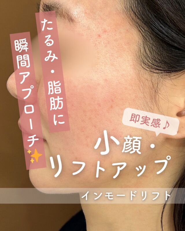 📸
【症例紹介】インモードリフト施術 3回後✨
⁡
気になる「口元のもたつき」や「フェイスラインのゆるみ」が、こんなにスッキリ👏

脂肪とたるみにアプローチするインモードリフトで、輪郭が引き締まり、小顔効果も◎
⁡
📍こんな方におすすめ
・頬〜あご周りのたるみが気になる
・脂肪がつきやすいフェイスラインをすっきりさせたい
・メスを使わずにリフトアップしたい

インモードリフトは、高周波の力でお肌の深部にアプローチし、たるみ改善・引き締め・小顔効果が期待できる人気の施術です。

痛みやダウンタイムも少なく、忙しい方にもおすすめです🌿

お悩みやご希望に合わせて、回数や施術間隔などもご提案させていただきますので、
まずはお気軽にカウンセリングへお越しくださいね💬✨

～インモードリフトって何？～
「フォーマ」で肌をじんわり温めて引き締め、
「ミニFX」で脂肪細胞にアプローチする2つの機能を組み合わせた最新小顔治療💆‍♀️
タイトニングと脂肪溶解、両方の効果が期待できます！

～こんな方におすすめ～
・フェイスラインのもたつきが気になる
・ダウンタイムは少なめがいい
・内出血が心配だけど効果はしっかりほしい
・切らずにリフトアップしたい

【料金案内】
☆インモードリフト（フォーマ＋ミニFXセット）初回：25,000円
☆通常：38,000円
☆3回コース：75,000円

☆フォーマ（両頬）初回：12,800円／通常：20,000円／3回：38,400円
☆ミニFX（両頬下またはアゴ下）初回：12,800円／通常：20,000円／3回：38,400円

・カウンセリング＋施術時間：メニューにより異なります
・施術中の痛み：個人差がありますが、痛みはほとんどなく、熱をじんわり感じる程度
・ダウンタイム：数日から1週間程度、赤み・腫れ・内出血が出る場合あり
・施術後のメイク：当日からOK
・リスク、副作用：内出血・腫れ・熱感・吸引性皮下出血・熱傷など（個人差あり）

⚠️DMでのお問い合わせはお受けしておりません。
お問い合わせは、クリニックへ直接お電話をお願いいたします🌱

————————————

ACCESS：大阪府大阪市北区茶屋町15-8
茶屋町ビル2階
TEL：06-6743-4652
営業時間：10時〜17時（最終受付16時）
お問合せ受付時間：10時〜19時

#インモードリフト #フォーマ #ミニFX #リフトアップ #たるみケア #小顔ケア #韓国 #美容皮膚科 #デザインビューティークリニック