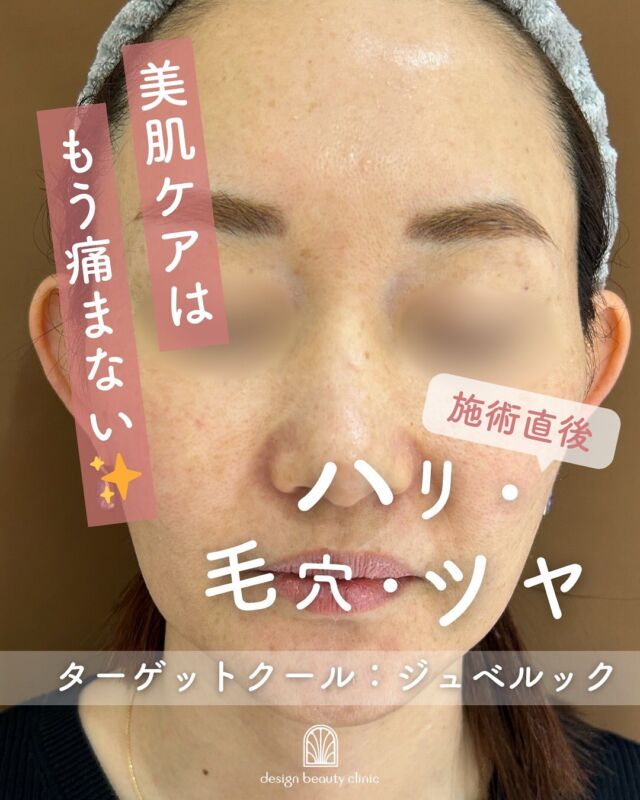 📸
施術直後のリアルなビフォーアフター
話題の「ターゲットクール × ジュベルック」

お肌の内側からふっくらとしたハリ感✨
赤みや腫れもほとんどなく、施術直後とは思えないナチュラルな仕上がりです。

💎ジュベルック：お肌の再生力を引き出し、ツヤと弾力をアップ
❄️ターゲットクール：冷却効果で痛みや赤みを最小限に

▶️痛み・ダウンタイムが少ないため、美容施術が初めての方にもおすすめ！
▶️大事な予定前も◎

理想のお肌への第一歩、一緒に始めてみませんか？

【美白】
初回16,500円
通常22,000円
3回コース49,500円

追加オプション
ボツラックス 9,800円

【ジュベルック】
初回32,000円
通常41,000円
3回コース96,000円

追加オプション
ボツラックス 9,800円

【ボツラックス】
通常 22,000円
⚠️初回、コースのご用意はございません。

※価格は全て税込です

ターゲットクールは、
冷却と同時に美容成分を
肌の奥まで届ける最新肌育治療✨

毛穴の引き締め、ハリ・ツヤUP
小じわケアまで即効アプローチ👌
施術時間は約15分、
ダウンタイムほぼなしで翌日からメイクOK。

こんな方におすすめ
✔ 痛みが苦手で肌育治療を諦めていた方
✔ ダウンタイムなしで即効性がほしい方
✔ 注射や針が苦手な方
✔ イベントや旅行前に肌を整えたい方

💠新感覚のひんやり美肌ケア、ぜひお試しください

⚠️DMでのお問い合わせはお受けしておりません。
お問い合わせは、クリニックへ直接お電話をお願いいたします🌱

————————————

ACCESS：大阪府大阪市北区茶屋町15-8
茶屋町ビル2階
TEL：06-6743-4652
営業時間：10時〜17時（最終受付16時）
お問合せ受付時間：10時〜19時

#美容皮膚科 #デザインビューティークリニック #ターゲットクール #ジュベルック #トラネキサム酸#美白