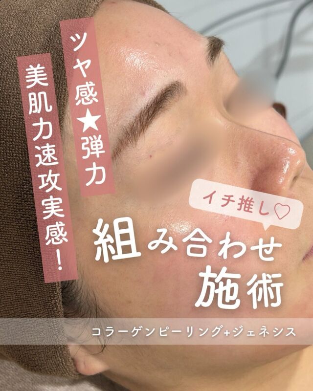 📸
症例写真のご紹介
今回は、**「コラーゲンピーリング + ジェネシス」**の組み合わせ施術のビフォーアフターをご紹介します✨

＼たった1回でもこの変化！／
お肌にふっくらとしたハリと、内側からのツヤ感がよみがえり、
写真でもしっかり変化がわかります🪞💕

🧴コラーゲンピーリングで古い角質をやさしくオフしながら、
肌の深部でコラーゲンの生成をしっかりサポート。
さらに、ジェネシスでお肌の内側を温め、キメを整えてふっくら美肌に✨

💄施術後すぐにメイクOK！
赤みもほとんど出ないので、ダウンタイムが心配な方にも安心。
大切なご予定の前にも、ぜひおすすめです♪

「最近お肌に元気がないかも…」
「イベント前にちょっと整えたい！」
そんな方にぜひ一度お試しいただきたいメニューです😊

📅カウンセリングだけでも大歓迎ですので、お気軽にご相談くださいね！

～コラーゲンピールとは？～
コラーゲンピールは、従来のケミカルピーリングと異なり、
皮膚を剥離せずに真皮層に作用してコラーゲンを生成を促し、赤ら顔、ハリツヤ、目元の小じわ、肌質改善の効果が期待できます。

・施術中の痛み：ほとんどなし
・ダウンタイム：赤みや乾燥、痒み等の肌荒れが生じる場合あり
・施術後のメイク：当日からOK
・効果：赤ら顔、ハリツヤ、目元の小じわ、肌質改善

●価格（全顔）
初回9,800円
通常15,800円
平日3回コース　29,400円
全日3回コース　39,400円
※全て税込価格

～ジェネシスって何？～
ジェネシスは、１施術で何役もこなす多彩な効果を持つため、いくつかの複合的な肌のお悩みにアプローチ出来ます。
主な効果はこちらになります。
・レーザーピーリング効果により、悪化したニキビやニキビ跡の改善を促し、毛穴の引き締めにも効果的ターンオーバーの乱れを正常な状態に近づける事によって、色素沈着の
改善や、シミのやくすみの改善
・真皮層に位置する微小血管を加熱し、血管壁や赤血球を破壊することによって、赤ら顔や毛細血管拡張症の改善
・真皮層に働きかけることでコラーゲンの生成を促し、ハリのあるきめ細やかな肌を作る

●価格（全顔）
初回3000shot：7,800円
通常3000shot：10,800円
初回6000shot：13,600円
通常6000shot：18,800円
・カウンセリング＋施術時間： 45分～60分
・施術中の痛み：ほとんどなし
・ダウンタイム： 赤みや熱感、痒み等の肌荒れが生じる場合あり
・施術後のメイク：当日からOK
・効果：赤ら顔、ハリツヤ、ニキビ痕の赤み、ニキビ痕の色素沈着、肌のキメなどの肌質改善

⚠️DMでのお問い合わせはお受けしておりません
お問い合わせは、クリニックへ直接お電話をお願いいたします🌱

-———————————

ACCESS：大阪府大阪市北区茶屋町15-8
茶屋町ビル2階
TEL：06-6743-4652
営業時間：10時〜17時
(最終受付時間：16時)
お問合せ受付時間：10時〜19時

#美容皮膚科 #美容外科 #美容クリニック #美肌 #女医 #ニキビ跡 #ニキビ痕 #保湿 #エイジングケア #肌質改善#ジェネシス#エレクトロポレーション