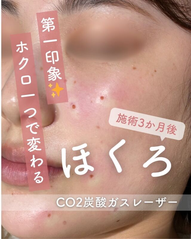 📸 
CO2レーザーでホクロ除去した方の経過写真をご紹介！
（施術直後 → 1か月 → 2か月 → 3か月）

「ホクロって取ったあとの跡、残るのかな…？」
そんな疑問をお持ちの方へ、実際の経過を写真でお見せします👀✨

🔍経過の流れはこんな感じ👇

🕐 施術直後 → 赤み＆かさぶたあり
📆 1か月後 → かさぶたが取れて、赤みが少し残る
📆 2か月後 → 赤みが落ち着いて、肌がなじんできた！
📆 3か月後 → かなり自然な肌色に。パッと見じゃ気づかないレベル👏

💡ポイント💡
ホクロ除去のあとは、3〜6か月くらいかけてゆっくり肌が安定していきます。
赤みや色味が完全に落ち着くには時間がかかるけど、日々少しずつキレイになっていく感じです🌿

紫外線ケア＆保湿をしっかりすることで、もっとキレイな仕上がりに✨

「このホクロ、前から気になってた…」という方、おすすめです☺️

～CO2ﾚｰｻﾞｰってなに？～
もともと皮膚には水分が多く含まれており、CO2レーザーを照射することで細胞内の水分が
反応し、熱エネルギーを発生させます。
この熱エネルギーが水分を瞬間的に蒸散することで皮膚が削られ、ホクロが除去されます。
さらに、レーザーを照射した部位周辺の血管は熱凝固作用で瞬時に固まるため、出血の心配はほとんどありません。
また、CO2レーザーの蒸散作用は皮膚の表面のみで、深い層まで届かないので除去後の創傷治癒も比較的早いというのが特徴です。
CO2ﾚｰｻﾞｰの注意点として、ホクロの大きさやメラニンの深さによって1度の施術で取り切れない可能性あります。
その場合の再施術は、前回の施術から3カ月以上空ける必要有り、一時的に患部がへこんだり、傷跡が残る場合もあります。
しっかりとテープ保護を行ってください。

☆3㎜以下：5,500円 / 個
☆8㎜以下：11,000円 / 個
☆茶テープ1巻(保護用)：700円
☆軟膏1本：700円
・カウンセリング＋施術時間：約１時間
・施術中の痛み：局所麻酔の際に軽度の痛み有り
　（※個人差あり）
・ダウンタイム：２週間程度テープ保護必要
・施術後のメイク：患部を避けて当日からOK

⚠️DMでのお問い合わせはお受けしておりません
お問い合わせは、クリニックへ直接お電話をお願いいたします🌱

————————————

ACCESS：大阪府大阪市北区茶屋町15-8
茶屋町ビル2階
TEL：06-6743-4652
営業時間：10時〜17時
(最終受付時間：16時)
お問合せ受付時間：10時〜19時

#美容皮膚科 #美容外科 #美容クリニック #ほくろ取り #co2炭酸ガスレーザー #黒子 #ホクロ除去