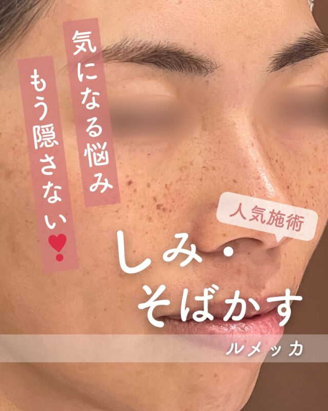 📸
【ルメッカ症例紹介】1回の施術でここまで変化✨
⁡
こちらは、ルメッカを1回施術された患者様の、施術直後と1週間後の比較写真です。
施術直後はシミ・そばかすが反応して一時的に濃く見えることがありますが、これはしっかり反応している証拠💡
⁡
1週間後にはかさぶたのように自然と剥がれ、キレイなお肌が見えてきます😊
この症例でも、そばかすが薄くなり、お肌のトーンも明るく見えますね！
⁡
✔️ そばかす・シミが気になる
✔️ お肌のトーンアップをしたい
という方におすすめの施術です🌿
⁡

～ルメッカって何？～
ルメッカは従来のIPLに比べて高出力・高反応の光治療。
シミ・そばかす・赤ら顔などの色ムラにアプローチしながら、
コラーゲン生成を促進し、肌のハリ・透明感も高めることができる美肌治療です🌿

【料金案内】
☆全顔初回：12,800円
☆全顔通常：20,000円
☆手の甲初回：12,800円
☆手の甲通常：20,000円

・カウンセリング＋施術時間：約1時間
・施術中の痛み：個人差はありますが、我慢できる程度です
・ダウンタイム：2～3日～1週間程度、赤みやひりつきが生じる場合あり（個人差あり）
・施術後のメイク：当日からOK
・効果：シミ・そばかす・赤ら顔の改善、肌のハリ・潤いアップ

シミが出来る原因としては様々な要因が考えられるため、
治療後もシミが増えない肌作りをしていくために、
日頃の生活習慣の改善やスキンケアの見直しは必須となります。
インナーケアの手助けになるサプリメント、スキンケアも数多く
取り扱っておりますので、お気軽にご相談ください。

⚠️DMでのお問い合わせはお受けしておりません。
お問い合わせは、クリニックへ直接お電話をお願いいたします🌱

————————————

ACCESS：大阪府大阪市北区茶屋町15-8
茶屋町ビル2階
TEL：06-6743-4652
営業時間：10時〜17時（最終受付16時）
お問合せ受付時間：10時〜19時

#ルメッカ #LUMECCA #光治療 #しみ治療 #シミ改善 #肌トーンアップ #フォトフェイシャル #美肌ケア #症例紹介#IPL光治療 #シミ治療 #そばかす改善 #赤ら顔治療 #肌質改善 #美白ケア #トーンアップ #美容皮膚科 #デザインビューティークリニック