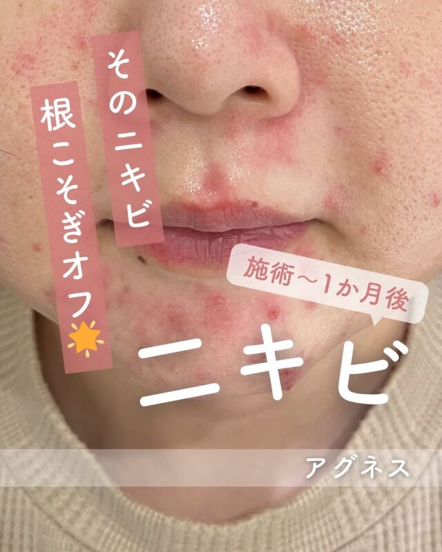 📸
【アグネス治療 Before → After】

《施術直後 ▶ 3日後 ▶ 1か月後》

繰り返すニキビにお悩みの方へ、
「アグネス治療」の症例をご紹介します✨

💡アグネスってなに？
アグネスは、ニキビの原因になっている皮脂腺（油を出すもと）をピンポイントで焼いて、再発しにくくする治療です！
「同じところに何回もニキビができる…」という方に、とってもおすすめ💡

🔄施術直後について
施術後は、赤みやニキビのような腫れが出ることがあります💦
これは、皮脂腺をしっかり焼いて中の炎症や皮脂が表に出ようとしている反応なので、一時的なものです◎

🌿数日〜1週間で落ち着いてくるので、ご安心ください！

📅3日後〜1か月後
✔ 3日後 → 赤みが少しずつ引いてきます
✔ 1か月後 → 炎症が落ち着き、ニキビの出にくい肌へチェンジ！
肌全体のトーンも整ってきます✨

「アグネスは“根本から治したい”人にこそ試してほしい治療。
繰り返しニキビに悩んでいた方ほど、変化を実感されています！」

【料金案内】
アグネス
☆全顔初回：39,800円
☆全顔通常：59,800円
☆部分初回：10,800円
☆部分通常：16,500円
※麻酔代別途：3,000円
※汗管腫の施術は上記とは異なる料金設定です

・カウンセリング＋施術時間：約1時間
・施術中の痛み：表面麻酔を使用します
・ダウンタイム：1週間前後、赤み・腫れ・熱感が生じる場合あり（個人差あり）
・施術後のメイク：術後3日以降から可能
・効果：ニキビ、汗管腫への改善

⚠️DMでのお問い合わせはお受けしておりません。
お問い合わせは、クリニックへ直接お電話をお願いいたします🌱

————————————

ACCESS：大阪府大阪市北区茶屋町15-8
茶屋町ビル2階
TEL：06-6743-4652
営業時間：10時〜17時（最終受付16時）
お問合せ受付時間：10時〜19時

#アグネス #ニキビ治療 #繰り返すニキビ #口周りニキビ #ニキビ