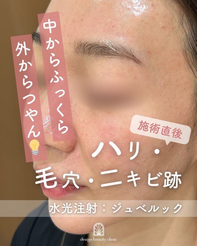 💉
【✨水光注射ジュベルック 施術直後の様子✨】

こちらは、水光注射ジュベルックの施術直後のお写真です📸
赤みやポツポツとした凹凸感が見られますが、このような反応は一時的なもので、通常は2〜3日ほどで落ち着いていきます。

今回の患者さまは、比較的ダウンタイムが少なめで、凹凸感も軽めの印象です😊

ジュベルックは、肌の内側から潤いとハリを与え、時間とともに自然なツヤ肌へ導いてくれる注入治療です。

「メイクでは叶えられないナチュラルなツヤ感がほしい」
「肌の土台から整えたい」
そんな方にぴったりの施術です💎

～ジュベルックって何？～
ジュベルックは、肌の再生を促し、毛穴や小じわ、ハリ不足を改善する肌育注射です。
『ドクター手打ち』と『水光注射機器』、お好みの方法で施術可能です💆‍♀️✨

～ジュベルックがおすすめな方～
・毛穴の開きや肌の凹凸が気になる
・ハリや弾力の低下を感じる
・ツヤのあるなめらかな肌を目指したい
・小じわやちりめんじわが気になる

～ハイコックス(水光注射機器)のメリット～
・均一かつスピーディーな薬剤注入が可能
・肌全体をムラなくアプローチ
・施術中の痛み・内出血が出にくく、ダウンタイムも少なめ

当院では韓国で人気の水光注射機器【ハイコックス】を使用✨
薬剤のロスが少なく、痛みも少ないので、初めての方にもおすすめです♪

【ジュベルック】
ジュベルックは
『ドクター手打ち』と『ハイコックス(水光注射機器)』の
2種類か打ち方を選べます❣️

■ドクター手打ち（全顔3cc）
通常：57,000円

■ハイコックス(水光注射機器)（全顔3cc）
初回：32,000円

通常：41,000円
3回コース：96,000円

・カウンセリング＋施術時間：約1時間
・施術中の痛み：チクっとした痛み、熱感あり
・ダウンタイム：赤み、凹凸感、内出血が2～7日程度出る場合あり

■ジュベルックについて
承認状況：国内未承認
入手経路：ネイチャーフォース・ジャパン社より入手
国内の承認医薬品の有無：同一の成分・性能を有する国内承認医薬品等はありません
諸外国における安全性情報：米国FDA・韓国KFDA承認

⚠️DMでのお問い合わせはお受けしておりません。
お問い合わせは、クリニックへ直接お電話をお願いいたします🌱

————————————

ACCESS：大阪府大阪市北区茶屋町15-8
茶屋町ビル2階
TEL：06-6743-4652
営業時間：10時〜17時（最終受付16時）
お問合せ受付時間：10時〜19時

#ジュベルック #水光注射 #ハイコックス #肌育注射 #コラーゲン生成 #ツヤ肌 #毛穴改善 #スキンブースター #美容皮膚科 #デザインビューティークリニック
⁡