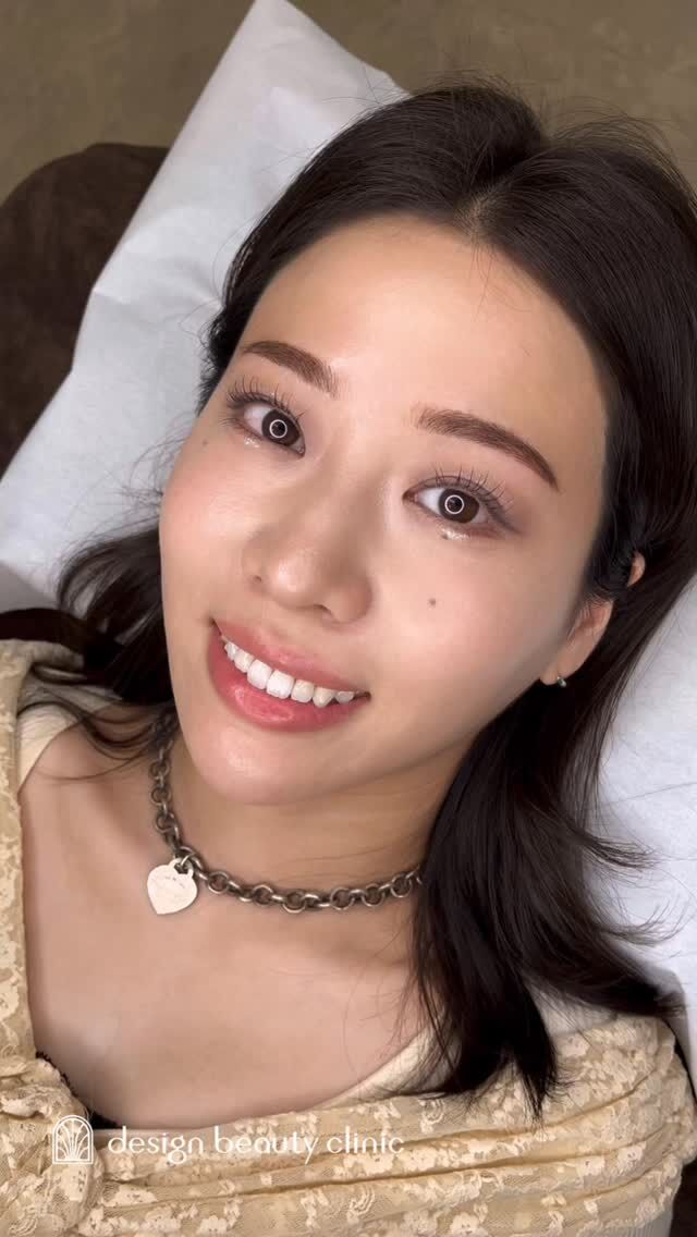 🪄
【🎀かわいさレベルUPする美容DAY🫧】

実は女性の3人に1人が
「眉毛の形の不揃い」に悩んでいるらしい💭

眉毛って顔のフレームだから、
ちょっと整えるだけで印象がガラッと変わるんです✨

垢抜けの近道は“眉”から🌿
自信がもてる眉で、かわいさレベルをぐっとUPしませんか？🪞

.

➤施術名：アートメイク眉毛　1回33,000円（税込）
➤施術の説明：皮膚の浅い層を専用針で傷をつけて色素を入れることにより、皮膚を着色する施術です。
➤リスク・副作用：炎症症状(発赤・腫脹・熱感・疼痛)、内出血、痒み、アレルギー反応、感染等。

⚠️DMでのお問い合わせはお受けしておりません
お問い合わせは、クリニックへ直接お電話をお願いいたします🌱

････････････････････････････････････････

■医療機関名
デザイン ビューティー クリニック

■ご予約方法
•WEB／LINE（プロフィールからリンクできます）
•電話

■電話番号（問い合わせ・予約）
メニューによって電話番号が異なります。

🌿アートメイク
　06-6616-8095

🌿美容皮膚科メニュー
　06-6743-4652

■店舗紹介
アートメイクは下記の3院どこでもお受けいただけます。

🎀梅田エリアで通いやすい方はこちら🎀
🏥梅田本院
〒530-0013 大阪府大阪市北区茶屋町15-8
茶屋町ビル2階

営業時間：10:00～19:00
定休日：不定休
診療メニュー：美容皮膚科 / アートメイク

🏥アートメイク梅田院
〒530-0014 大阪府大阪市北区鶴野町2-1
梅田タナダビル１階

営業時間：10:00～19:00
定休日：不定休
診療メニュー： アートメイク

🎀 心斎橋・難波(なんば)エリアで通いやすい方はこちら🎀
🏥アートメイク心斎橋院
〒542-0083 大阪市中央区東心斎橋1-20-14
心斎橋エルナ岩崎ビル5階

営業時間：10:00～19:00
定休日：不定休
診療メニュー： アートメイク

････････････････････････････････････････

#アートメイク #美容クリニック #アートメイク眉 #アートメイクリップ #眉アート #アートメイク大阪 #梅田 #心斎橋 #難波