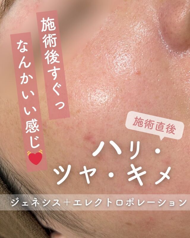 ✨
【施術直後の症例紹介】 
ジェネシス × エレクトロポレーションのコンビネーション施術を受けられた患者様の、施術直後のお写真です📸
お肌のハリ・ツヤがぐっと増し、キメが整っているのがすぐにわかります✨
ジェネシスでお肌の土台を整えながら、エレクトロポレーションで美容成分をしっかり導入することで、内側からふっくらとした健康的な美肌に導きます💆♀️💫
ダウンタイムはほとんどなく、施術当日からお化粧もOK!
大切なご予定の前や、定期的な肌メンテナンスとしてもとてもおすすめの施術です🌿
📍ジェネシス+エレクトロポレーション
☑️ハリ・ツヤ・透明感アップ
☑️毛穴やくすみの改善
☑️ダウンタイムほぼなし
────────────
季節の変わり目や、お肌がゆらぎやすい時期のケア、ちょっと贅沢なご褒美にもぴったりのメニュー✨
気になる方は、お気軽にご相談ください♪
~ジェネシス~
マイルドなレーザーのため、体感としては温かい熱のシャワーを浴びているような感覚で、照射時は痛みがほとんどありません。
☆初回3000shot:7,800円
☆通常3000shot:10,800円
☆初回6000shot:13,600円
☆通常6000shot:18,800円
・カウンセリング+施術時間: 45分~60分
・施術中の痛み:ほとんどなし
・ダウンタイム: 赤みや熱感、痒み等の肌荒れが生じる場合あり
・施術後のメイク:当日からOK
・効果:赤ら顔、ハリツヤ、ニキビ痕の赤み、ニキビ痕の色素沈着、肌のキメなどの肌質改善
~エレクトロポレーション~
エレクトロポレーションはノーニードルセラピーといわれ、針を使わず美容成分をお肌の奥まで浸透させる新しい導入法です。
乾燥が気になる時やイベント前のケア✨にも大変おすすめです。
お痛みやダウンタウンもなどもありません。
☆初回:5,500円
☆通常:6,600円
・カウンセリング+施術時間:約60分
・施術中の痛み:電流によるピリピリ感があります。(個人差があります)
・ダウンタイム:なし
・施術後のメイク:当日からOK
・効果:美容成分導入・保湿・鎮静
◾️追加薬剤オプション
各3,300円
⭐︎美白(ビタミンC+トラネキサム酸)
⭐︎ニキビ(ビタミンC+ビタミンB)
⭐︎エイジング(ビタミンE+EMN)
上記オプションに➕550円で、
さらにビタミンCの追加が可能❤️
※全て税込価格
⚠️DMでのお問い合わせはお受けしておりません
お問い合わせは、クリニックへ直接お電話をお願いいたします🌱
-———————————
ACCESS:大阪府大阪市北区茶屋町15-8
茶屋町ビル2階
TEL:06-6743-4652
営業時間:10時〜17時
(最終受付時間:16時)
お問合せ受付時間:10時〜19時
#美容皮膚科 #美容外科 #美容クリニック #美肌 #女医 #ニキビ跡 #ニキビ痕 #保湿 #エイジングケア #肌質改善#ジェネシス#エレクトロポレーション