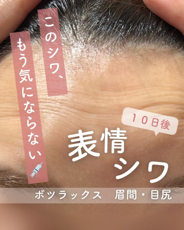 ✨
【ボツラックス注入:額・眉間の症例紹介】
こちらは、ボツラックスによる額と眉間への注入を同時に行った症例です💉
施術直後から「表情がやわらかくなった」と感じていただけることが多く、
特に額と眉間を同時に施術することで、より自然でバランスの取れた仕上がりが期待できます😊
💡額と眉間を同時に施術するメリット
🔸 額の横ジワと眉間の縦ジワ、両方の動きを整えることで全体の表情が自然に✨
🔸 一部だけを止めることで起こる“つっぱり感”や“眉が重く見える”などの違和感を軽減🌿
🔸 シワの予防効果も高まり、今後のエイジングケアとしてもおすすめ💎
ボツラックスは、ボトックスと同じ有効成分を使用した製剤で、
表情ジワの改善に効果的ながら、自然な表情を残すことができるのが特徴です✨
⏰ 効果の目安
・2~3日後:少しずつ筋肉の動きが穏やかに
・1~2週間後:シワが目立ちにくくなり、なめらかなおでこに
・3~4ヵ月程度:効果が持続(個人差あり)
ナチュラルで上品な印象を目指す方におすすめの施術です💐
気になる表情ジワは、早めのケアで未来のお肌に差をつけましょう☺️
~ボツラックスって何?~
表情ジワは日常生活で表情筋を動かすことにより、お顔の筋肉が鍛えられ形成されてしまいます。
ボツラックス注射は、神経毒を筋肉に注入することで、
小顔やシワ改善などの美容効果が期待できる治療法です。
たとえば、顔のエラ部分に注射することで、エラの筋肉の
ボリュームが減り、フェイスラインをスッキリとさせることができます。
その他では汗を抑えたり、肩こり改善が期待できる治療方法です。
💉ボツラックスの効果持続期間
個人差はありますが3~4ヶ月程度とされています。
注射を行ってから2〜3日程度で効果があらわれはじめ、徐々にシワや多汗症などが改善されて、1ヶ月かけて身体に馴染んでいきます。
3〜4ヶ月をピークに徐々に効果が薄れていき、治療から6ヶ月経つ頃には効果もなくなっていることがほとんどです。
ボツラックス注射の効果を維持するために、4〜6ヶ月に一回定期的に施術を受けることがお勧めです。
■額or眉間or目尻or目の下or顎
各:6,000円
・カウンセリング+施術時間:30分
・施術中の痛み:チクっとした痛みあり
(※個人差あり)
(※表面麻酔希望の場合:+3,000円)
・ダウンタイム:内出血がでる場合もありますが、徐々に落ち着きます。
ボツラックスは熱に弱い為、薬剤が安定するまでの1週間は血行を促進させるサウナや岩盤浴などは控えてください。
・施術後のメイク:施術部位を避ければ当日から可能
・効果:表情ジワの改善、エラの改善、小顔効果、肩こり改善、多汗症の改善
■ボツラックス
ボツラックス(Botulax)は、韓国のHugel社が製造したA型ボツリヌス毒素を有効成分とする薬剤です。
承認状況:国内未承認
入手経路:PRSS社より入手
国内の承認医薬品などの有無:同一の成分や性能を有する他の国内承認医薬品等はありません
諸外国における安全性等に係る情報:韓国の食品医薬品安全庁(KFDA)
⚠️DMでのお問い合わせはお受けしておりません
お問い合わせは、クリニックへ直接お電話をお願いいたします🌱
————————————
ACCESS:大阪府大阪市北区茶屋町15-8
茶屋町ビル2階
TEL:06-6743-4652
営業時間:10時〜17時
(最終受付時間:16時)
お問合せ受付時間:10時〜19時
#美容皮膚科 #美容外科 #美容クリニック #エイジング #アンチエイジング #シワ #ボツラックス #ボトックス#デザインビューティクリニック#表情ジワ