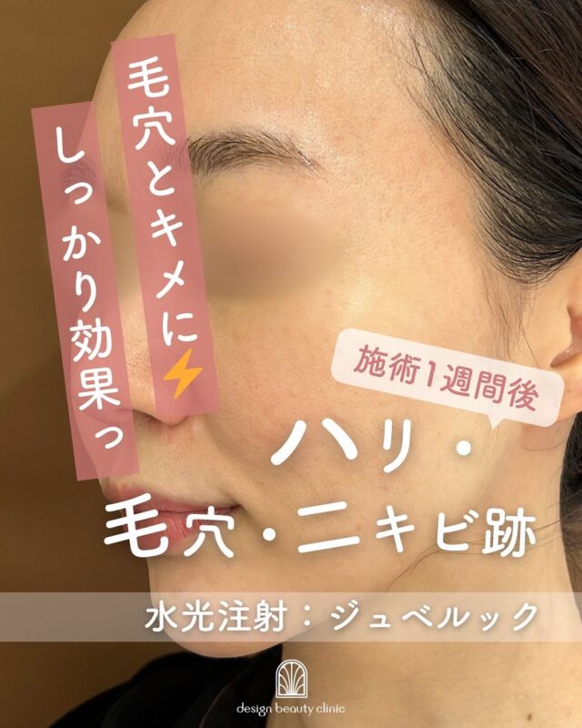 ✨
水光注射〈ジュベルック〉施術1週間後

ジュベルック施術から1週間後のお写真です📸
お肌のキメがふっくら整い、頬や額の毛穴もキュッと引き締まってきました💎✨

ジュベルックはPCL（ポリ乳酸）成分によって、
時間をかけてコラーゲン生成を促す“遅延型”スキンブースター💉🌿

即効性よりも、「じっくり自分の肌力を育てる」タイプの水光注射なので、
ここからさらにツヤ・ハリ・弾力の変化を感じていただけます💫

自然なツヤ肌を目指したい方、肌の土台から整えたい方におすすめです🤍✨

～ジュベルックって何？～
ジュベルックは、肌の再生を促し、毛穴や小じわ、ハリ不足を改善する肌育注射です。
『ドクター手打ち』と『水光注射機器』、お好みの方法で施術可能です💆‍♀️✨

～ジュベルックがおすすめな方～
・毛穴の開きや肌の凹凸が気になる
・ハリや弾力の低下を感じる
・ツヤのあるなめらかな肌を目指したい
・小じわやちりめんじわが気になる

～ハイコックス(水光注射機器)のメリット～
・均一かつスピーディーな薬剤注入が可能
・肌全体をムラなくアプローチ
・施術中の痛み・内出血が出にくく、ダウンタイムも少なめ

当院では韓国で人気の水光注射機器【ハイコックス】を使用✨
薬剤のロスが少なく、痛みも少ないので、初めての方にもおすすめです♪

【ジュベルック】
ジュベルックは
『ドクター手打ち』と『ハイコックス(水光注射機器)』の
2種類か打ち方を選べます❣️

■ドクター手打ち（全顔3cc）
通常：57,000円

■ハイコックス(水光注射機器)（全顔3cc）
初回：32,000円

通常：41,000円
3回コース：96,000円

・カウンセリング＋施術時間：約1時間
・施術中の痛み：チクっとした痛み、熱感あり
・ダウンタイム：赤み、凹凸感、内出血が2～7日程度出る場合あり

■ジュベルックについて
承認状況：国内未承認
入手経路：ネイチャーフォース・ジャパン社より入手
国内の承認医薬品の有無：同一の成分・性能を有する国内承認医薬品等はありません
諸外国における安全性情報：米国FDA・韓国KFDA承認

⚠️DMでのお問い合わせはお受けしておりません。
お問い合わせは、クリニックへ直接お電話をお願いいたします🌱

————————————

ACCESS：大阪府大阪市北区茶屋町15-8
茶屋町ビル2階
TEL：06-6743-4652
営業時間：10時〜17時（最終受付16時）
お問合せ受付時間：10時〜19時

#ジュベルック #水光注射 #ハイコックス #肌育注射 #コラーゲン生成 #ツヤ肌 #毛穴改善 #スキンブースター #美容皮膚科 #デザインビューティークリニック