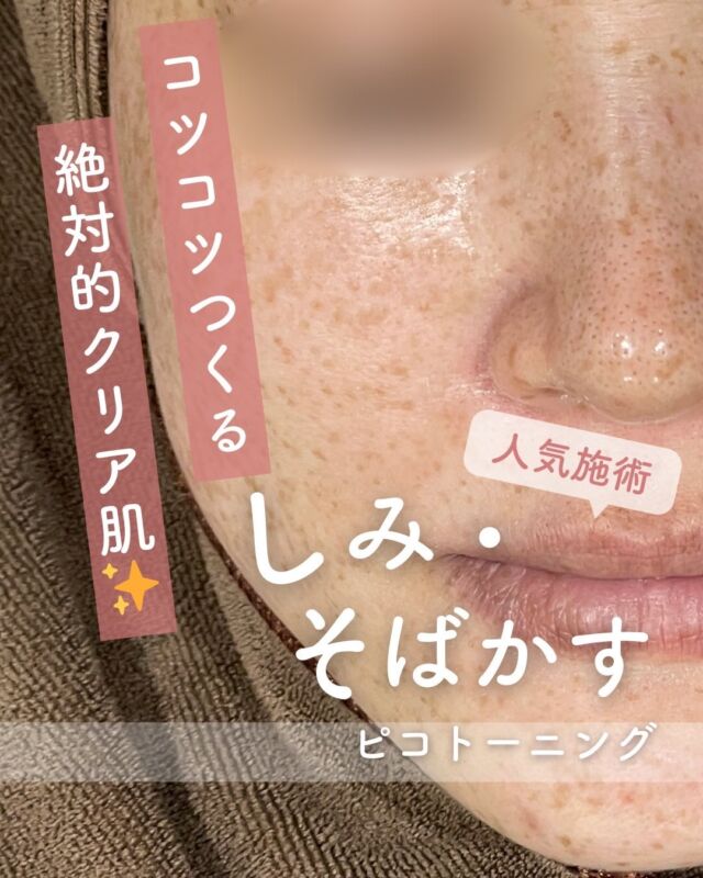 🌈✨ 
ピコトーニング20回コースのビフォーアフターをご紹介！ ✨🌈

今回はピコトーニングを20回継続して受けていただいた患者様の症例をご紹介します。

ピコトーニングは、微細なレーザーでお肌全体にアプローチすることで
✨ 肌トーンアップ
✨ くすみ改善
✨ しみ・そばかすにも効果的
と、さまざまなお悩みに嬉しい変化が期待できる人気施術です💎

今回の患者様も、継続するごとに…
🌟 お肌がワントーン明るく透明感アップ
🌟 全体的に色むらが整い、均一な肌質へ
🌟 気になっていたしみ・そばかすも徐々に目立ちにくい印象に
と、とても素敵な変化がみられました！

📸 1回目 → 10回目 → 20回目の経過写真も掲載中！
「継続するとこんなに変わるんだ！」と実感していただける症例です💗

当院では、お肌の状態に合わせて無理なく続けられる施術ペースをご提案しています。
「しみ・そばかすが気になる…」
「お肌を明るくしたい！」
「まずは相談だけしてみたい」
そんな方も大歓迎です😊🌷

皆さまの理想のお肌に近づけるよう、
やさしく丁寧にサポートさせていただきます✨

☆初回価格：9,800円
☆通常価格：15,800円

・カウンセリング+施術時間：約1時間
・施術中の痛み：ゴムで弾かれたような体感
（※個人差あり。）
・ダウンタイム：ほぼ無し
（※個人差あり。稀に膨隆疹、赤み、乾燥）
・施術後のメイク：即可能
・効果：肝斑改善、しみ、くすみ、
肌のハリ改善、毛穴の開き改善

————————————

ACCESS：大阪府大阪市北区茶屋町15-8
茶屋町ビル2階
TEL：06-6743-4652
営業時間：10時〜17時
(最終受付時間：16時)
お問合せ受付時間：10時〜19時

⚠️DMでのお問い合わせはお受けしておりません
お問い合わせは、クリニックへ直接お電話をお願いいたします🌱

#美容皮膚科 #美容外科 #美容クリニック #美肌 #女医 #美白 #アンチエイジング #シミ取り #レーザートーニング #肌質改善 #しみ#ピコトーニング