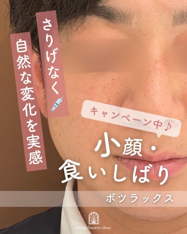 ✨
【症例紹介エラボツラックス（エラボトックス）1か月後】

エラの張りが気になっていた患者さまの、施術から1か月後のお写真です📸✨
フェイスラインがすっきりと整い、自然でやわらかな印象になっているのがお分かりいただけます😊💗
さりげなく変化を実感できるため、男女問わずとても人気の施術です✨

そして…
🎄**12月はエラボツラックスのキャンペーン実施中！**🎁
初めての方も、リピートの方も大歓迎です🙌
ぜひこの機会に、お気軽にご相談くださいね💐

自然で美しいフェイスラインづくりを、心を込めてサポートいたします💆‍♀️💖

✅ 歯ぎしり・食いしばりにお悩みの方にもおすすめ！

夜間の歯ぎしりや、日中の無意識な食いしばりがある方は、咬筋が過度に発達しやすくなります。
ボツラックスを注入することで、筋肉の緊張が和らぎ、歯や顎への負担を軽減する効果も期待できます🦷✨

「顔が大きく見えるのが気になる」
「エラ張りがコンプレックス」
「歯ぎしりで顎が痛くなる…」
そんなお悩みをお持ちの方は、ぜひ一度ご相談ください😊

■ボツラックス
ボツラックス（Botulax）は、韓国のHugel社が製造したA型ボツリヌス毒素を有効成分とする薬剤です。
承認状況：国内未承認
入手経路：PRSS社より入手
国内の承認医薬品などの有無：同一の成分や性能を有する他の国内承認医薬品等はありません
諸外国における安全性等に係る情報：韓国の食品医薬品安全庁（KFDA）

⚠️DMでのお問い合わせはお受けしておりません
お問い合わせは、クリニックへ直接お電話をお願いいたします🌱

————————————

ACCESS：大阪府大阪市北区茶屋町15-8
茶屋町ビル2階
TEL：06-6743-4652
営業時間：10時〜17時
(最終受付時間：16時)
お問合せ受付時間：10時〜19時

#美容皮膚科 #美容外科 #美容クリニック #ボツラックス #ボトックス #しわ #エイジング #アンチエイジング #小顔