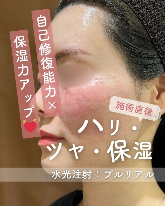 📸
《症例紹介：水光注射プルリアル》施術直後～2週間の変化✨

今回は、水光注射プルリアルの
《施術直後 → 2週間後》の肌変化をご紹介します。

プルリアルは、うるおい成分をバランスよく配合した製剤で、
肌本来の自己修復力をサポートしながら、内側からの保湿力を高めてくれるのが大きな特⻑です。

💧なぜ “自己修復力 + 保湿力アップ” が大切？

✔ 乾燥ダメージを受けにくい肌に整う
✔ うるおいに満ちた“つや感”が出やすい
✔ メイクのノリが安定する
✔ ハリが生まれ、全体のトーンがなめらかに見える

肌がしっかり水分を抱えられるようになると、
外側からのスキンケアだけでは届きにくい部分にもアプローチでき、
結果として“ゆらぎにくい肌づくり”につながります✨

🩵【ダウンタイムについて】
施術直後は赤みや点状の針跡が見られますが、多くの方が3日ほどで落ち着き始め、1週間後にはほとんど目立たない自然な肌に✨
2週間後には肌の内側からふっくらとしたハリや、うるおいのあるツヤ感を実感できます🪞

💎【プルリアル デンシファイの特徴】
・高濃度ヒアルロン酸＋アミノ酸複合成分配合
・コラーゲン密度の向上をサポート
・たるみ・小ジワ・乾燥が気になる肌に根本からアプローチ
・注入後も自然な仕上がりで表情の邪魔をしない
・敏感肌の方にも配慮された低刺激処方

🧡 特に「年齢肌によるボリュームロス」や「うるおい不足」にお悩みの方におすすめ。
当院では、専用の9本針を使った「ハイコックス水光注射」で、製剤を均一かつ浅層に丁寧に届けています。

🗓️ 気になるダウンタイムも、今回の症例写真でしっかりご確認いただけます。自然に美しく整う肌を、ぜひ体感してみてください🌿

〜プルリアルって何？〜
プルリアルは、ヒアルロン酸をベースにアミノ酸やミネラルなどを豊富に含んだ“肌育注射”。
肌再生を促し、ハリ・ツヤ・弾力・乾燥小じわの改善を目指すスキンブースターです✨

〜ハイコックス（水光注射）のメリット・特徴〜
・専用機器で均一な深さ・量をスピーディーに注入
・全体にまんべんなく広がることでムラが少なく、仕上がりがなめらか
・施術直後は点状の赤みや針跡が出ることもありますが、比較的ダウンタイムは軽めです

【プルリアル】
プルリアルは
『ドクター手打ち』と『ハイコックス（水光注射機器）』の
2種類の方法からお選びいただけます❣️

■ドクター手打ち（全顔2cc）
77,000円

■ハイコックス(水光注射機器)（全顔2cc）
52,000円

※各施術、別途麻酔代3,000円

・カウンセリング＋施術時間：約1〜1.5時間
・施術中の痛み：チクっとした痛み、熱感あり（※表面麻酔使用）
・ダウンタイム：赤み、凹凸感、内出血が2～7日程度出る場合あり

■プルリアルについて
承認状況：国内未承認
国内の承認医薬品の有無：同一の成分・性能を有する他の国内承認医薬品等はありません
諸外国における安全性情報：CE認証

⚠️DMでのお問い合わせはお受けしておりません。
お問い合わせは、クリニックへ直接お電話をお願いいたします🌱

————————————

ACCESS：大阪府大阪市北区茶屋町15-8
茶屋町ビル2階
TEL：06-6743-4652
営業時間：10時〜17時（最終受付16時）
お問合せ受付時間：10時〜19時

#プルリアルデンシファイ #水光注射 #ハイコックス #スキンブースター #ヒアルロン酸注射 #エイジングケア #肌の再構築 #ダウンタイムレポート #美容クリニック症例 #肌質改善 #美肌治療