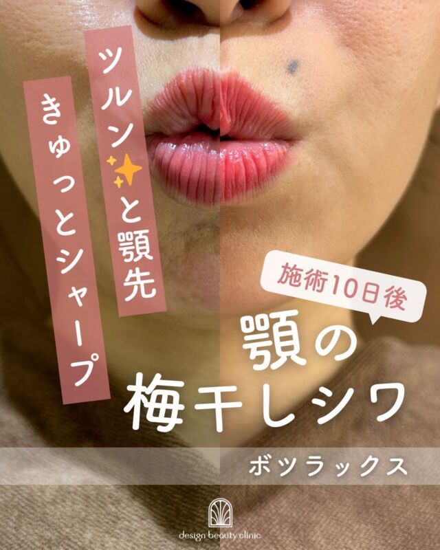 💫
顎ボツラックス《ボトックス》：施術10日後

顎ボツラックス《ボトックス》施術から10日後の経過です💛
力が入りやすかった顎の梅干しジワがスッと消えて、顎先がツルンと滑らかに。
さらに、顎先のラインが整い、フェイスラインまでシュッとシャープに見えるようになりました✨

そして今の時期は、キャンペーン中のハイフとの併用がとてもおすすめ！
顎ボトックスで余計な力みを和らげ、ハイフでしっかり引き締めることで、
よりスッキリとしたフェイスラインを目指せます💎

気になる方はお気軽にご相談ください🌼
理想のフェイスラインづくりをサポートします💛

■ボツラックス
ボツラックス（Botulax）は、韓国のHugel社が製造したA型ボツリヌス毒素を有効成分とする薬剤です。
承認状況：国内未承認
入手経路：PRSS社より入手
国内の承認医薬品などの有無：同一の成分や性能を有する他の国内承認医薬品等はありません
諸外国における安全性等に係る情報：韓国の食品医薬品安全庁（KFDA）

⚠️DMでのお問い合わせはお受けしておりません
お問い合わせは、クリニックへ直接お電話をお願いいたします🌱

————————————

ACCESS：大阪府大阪市北区茶屋町15-8
茶屋町ビル2階
TEL：06-6743-4652
営業時間：10時〜17時
(最終受付時間：16時)
お問合せ受付時間：10時〜19時

#美容皮膚科 #美容外科 #美容クリニック #エイジング #アンチエイジング #シワ #ボツラックス #ボトックス#デザインビューティクリニック