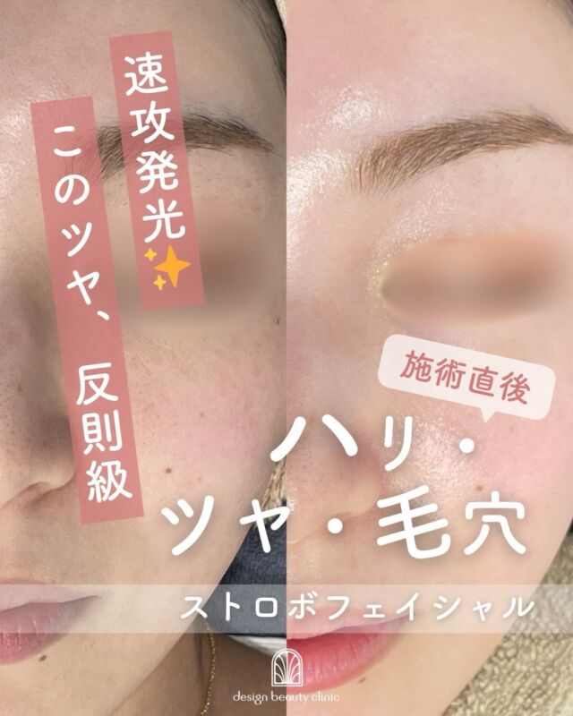 📸 
ストロボフェイシャル施術直後の症例です✨

速攻発光
このツヤ、反則級💫

ストロボフェイシャルは、
🫧 ハイドラジェントルで毛穴の汚れや古い角質をやさしく洗浄し、
✨ コラーゲンピーリングでお肌にうるおいとハリを与える、
2つの施術を組み合わせたフェイシャルメニューです🌿

施術直後からお肌全体にツヤがしっかりと出て、内側からふっくらとしたハリ感が感じられます✨
キメが整うことで光をきれいに反射し、透明感のあるなめらかな肌印象に☺️

ハイドラジェントルでは毛穴汚れをすっきりオフするので
✔ 毛穴の目立ち
✔ ザラつき
✔ くすみ
が気になる方にもおすすめ🌸

ダウンタイムがほとんどないため、施術後すぐにメイクやお出かけができるのも嬉しいポイント💄💕

◼️ストロボフェイシャル価格

初回 19,600円（税込）
通常 25,000円（税込）

【ハイドラジェントル】
・施術中の痛み：ひりつきを伴う場合あり
・ダウンタイム： 赤みや熱感、痒み等の肌荒れが生じる場合あり
・施術後のメイク：当日からOK
・効果：黒ずみ・ざらつきの改善、肌のトーンアップ、ハリ・艶感アップ

【コラーゲンピール】
・施術中の痛み：ほとんどなし
・ダウンタイム：赤みや乾燥、痒み等の肌荒れが生じる場合あり
・施術後のメイク：当日からOK
・効果：赤ら顔、ハリツヤ、目元の小じわ、肌質改善

-———————————

ACCESS：大阪府大阪市北区茶屋町15-8
茶屋町ビル2階
TEL：06-6743-4652
営業時間：10時〜17時
(最終受付時間：16時)
お問合せ受付時間：10時〜19時

#美容皮膚科 #美容外科 #美容クリニック #ストロボフェイシャル #ハイドラジェントル ハイドラフェイシャル コラーゲンピール マッサージピール 毛穴撲滅 毛穴治療 毛穴洗浄 ピーリング