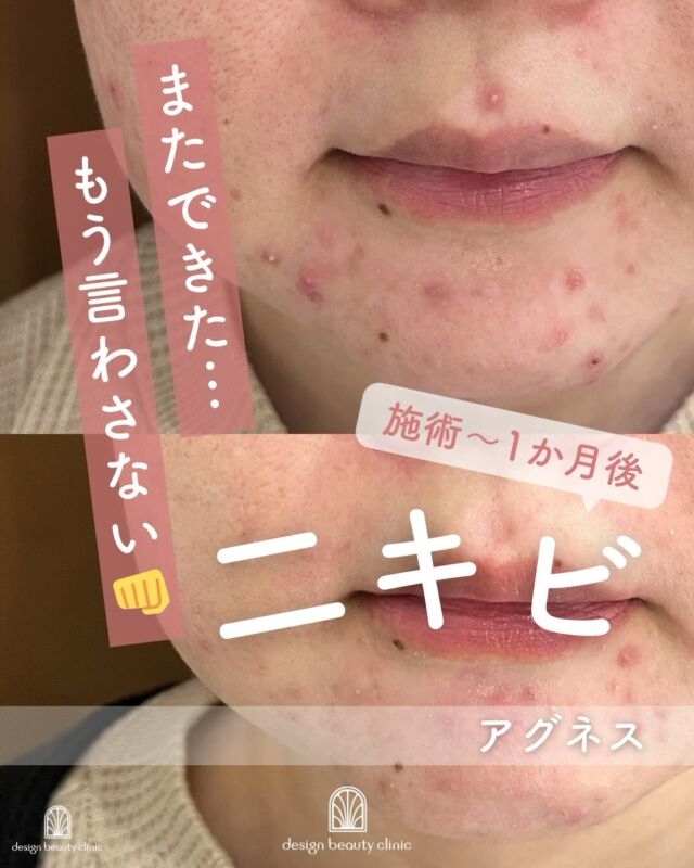 📸
症例紹介🌿アグネス（ニキビ治療）

施術直後〜1か月後の経過をご紹介します✨
アグネスは、ニキビの原因となる皮脂腺に直接アプローチする治療です💡

施術後しばらくは、
⚠️ 溜まっていた皮脂が外に出てくることで
 一時的にニキビが増えたり、悪化したように感じることがあります

ですがこれは治癒に向かう過程のひとつ🌱
時間の経過とともに炎症が落ち着き、
1か月後にはニキビの改善や新しいニキビができにくいお肌へと変化していきます✨

「繰り返すニキビに悩んでいる…」
「根本的な治療をしたい！」
そんな方におすすめの治療です😊💖

～アグネスって何？～
アグネスは、選択的に皮脂腺を破壊することで、
ニキビの原因を根本から治療する本質的なニキビ治療治療です。
「毛根を破壊して脱毛ができる」のと同様に、
破壊された皮脂腺は再生せず、長期的なニキビ予防効果が期待できます💥

～アグネスがおすすめな方～
・繰り返す炎症性ニキビに悩んでいる
・口周りや顎にニキビができやすい
・他の治療で改善しなかった
・ニキビ痕や赤みが残っている

また、以下の治療と併用することで相乗効果が高まります👇
◇サリチル酸ピーリング（不要な角質ケア）
◇エレクトロポレーション（炎症抑制＆薬剤導入）
◇ジェネシス（ニキビ痕・赤みケア）

【料金案内】
☆全顔初回：39,800円
☆全顔通常：59,800円
☆部分初回：10,800円
☆部分通常：16,500円
※麻酔代別途：3,000円
※汗管腫の施術は上記とは異なる料金設定です

・カウンセリング＋施術時間：約1時間
・施術中の痛み：表面麻酔を使用します
・ダウンタイム：1週間前後、赤み・腫れ・熱感が生じる場合あり（個人差あり）
・施術後のメイク：術後3日以降から可能
・効果：ニキビ、汗管腫への改善

⚠️DMでのお問い合わせはお受けしておりません。
お問い合わせは、クリニックへ直接お電話をお願いいたします🌱

————————————

ACCESS：大阪府大阪市北区茶屋町15-8
茶屋町ビル2階
TEL：06-6743-4652
営業時間：10時〜17時（最終受付16時）
お問合せ受付時間：10時〜19時

#アグネス #ニキビ治療 #繰り返すニキビ #口周りニキビ #皮脂腺破壊 汗管腫 美容皮膚科 ダウンタイム経過 ニキビ跡予防 ニキビ治療経過デザインビューティークリニック