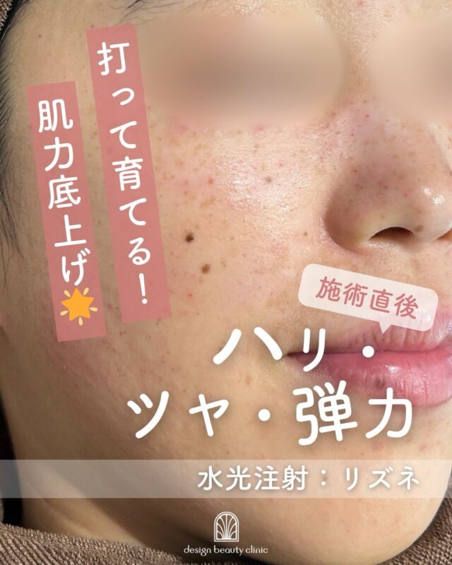 💉
水光注射リズネ｜施術直後

今はちょっと赤み＆ポコポコ感あり⚡
でもこれはうるおいを入れた直後のサイン。

🕒 赤み・凸凹感は約2〜3日で落ち着いていきます
※個人差あり／大切な予定前は余裕をもって◎

🌱 肌育注射って？
その場だけキレイにするんじゃなくて、
肌の土台からコンディションを整えて、調子のいい肌を育てるケア。

✨ リズネで期待できること
・うるおい感UP
・キメのなめらかさ
・ツヤ感
・「最近、肌いいかも」な安定感

📅 数日後、肌の変化をお楽しみに♬

～リズネがおすすめな方～
・毛穴の開きや小じわが気になる
・肌のハリや弾力が低下してきた
・凹凸やちりめんじわを改善したい
・お肌の内側からの再生を目指したい

～ハイコックス(水光注射機器)のメリット～
・均一かつスピーディーな薬剤注入が可能
・肌全体をムラなくアプローチ
・施術中の痛み・内出血が出にくく、ダウンタイムも少なめ

当院では韓国で人気の水光注射機器【ハイコックス】を使用✨
薬剤のロスが少なく、痛みも少ないので、初めての方にもおすすめです♪

【リズネ】
リズネは
『ドクター手打ち』と『ハイコックス（水光注射機器）』の
2種類の打ち方からお選びいただけます❣️

■ドクター手打ち（全顔2cc）
通常：57,000円

■ハイコックス（水光注射機器）（全顔2cc）
初回：32,000円
通常：41,000円
3回コース：96,000円

・カウンセリング＋施術時間：約1時間
・施術中の痛み：チクっとした痛み、熱感あり（※表面麻酔使用）
・ダウンタイム：赤み、凹凸感、内出血が2～7日程度出る場合あり

■リズネについて
承認状況：国内未承認
入手経路：ARM社より入手
国内の承認医薬品などの有無：同一の成分や性能を有する他の国内承認医薬品等はありません
諸外国における安全性等に係る情報：韓国の食品医薬品安全庁（KFDA）の承認びCE認証

⚠️DMでのお問い合わせはお受けしておりません。
お問い合わせは、クリニックへ直接お電話をお願いいたします🌱

————————————

ACCESS：大阪府大阪市北区茶屋町15-8
茶屋町ビル2階
TEL：06-6743-4652
営業時間：10時〜17時（最終受付16時）
お問合せ受付時間：10時〜19時

#リズネ #肌育注射 #水光注射 #スキンブースター #ハリ肌 ツヤ肌 毛穴改善 リジュラン 韓国美容 美容皮膚科 デザインビューティークリニック