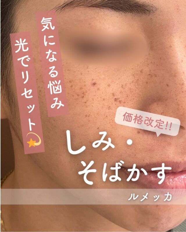 📸
ルメッカの症例をご紹介します✨

【施術直後 ▶︎ 1週間後】

1回の施術でも、
✔ シミ
✔ そばかす
✔ くすみ

がすっきりしているのが分かりますよね☺️💫

ルメッカは、肌悩みに反応する光を照射することで
メラニンにアプローチする光治療です✨

施術直後は、
シミやそばかすが一時的に濃く浮き出たように見えることがあります👀
これはしっかり反応しているサイン🌟

その後、数日〜1週間ほどで
反応した部分が自然に薄くなり、
明るくクリアな印象のお肌へ🤍

✔ シミ・そばかす
✔ くすみ・赤み
✔ 透明感アップ

「シミ・そばかすをどうにかしたい」
「肌の印象を明るくしたい」
そんな方はぜひ一度ご相談ください🫶✨

(index pointing right)大人気のシミ治療『ルメッカ』が、
より通いやすい価格になりました✨

【ルメッカ 料金】
・初回　9,800円（税込）
・通常　15,800円（税込）
・3回コース　29,400円（税込）

⚠️DMでのお問い合わせはお受けしておりません
お問い合わせは、クリニックへ直接お電話をお願いいたします🌱

————————————

ACCESS：大阪府大阪市北区茶屋町15-8
茶屋町ビル2階
TEL：06-6743-4652
営業時間：10時〜17時
(最終受付時間：16時)
お問合せ受付時間：10時〜19時

#美容皮膚科 #美容外科 #美容クリニック#ルメッカ