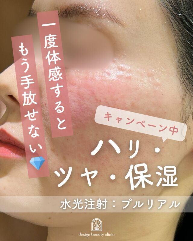 💎水光注射「プルリアル」症例紹介💎

こちらは施術直後〜2週間後の経過写真です📸
お写真からもわかるように、お肌のハリ・ツヤ感がしっかりアップしています✨
内側からうるおいが満ちたような、みずみずしい印象に🌿

施術直後は、
🔸赤み
🔸注射によるポコポコとした凹凸感

が出ることがありますが、数日ほどで徐々に落ち着き、ほとんど気にならなくなる方がほとんどです☺️
ダウンタイムが比較的短いのも水光注射の魅力のひとつです。

プルリアルは、
✔️ハリ・ツヤを出したい
✔️乾燥や小ジワが気になる
✔️自然な若々しさが欲しい

そんな方におすすめの施術です💆‍♀️✨

お肌の土台ケアとして、ぜひ一度ご相談ください🌸

💎【プルリアル デンシファイの特徴】
・高濃度ヒアルロン酸＋アミノ酸複合成分配合
・コラーゲン密度の向上をサポート
・たるみ・小ジワ・乾燥が気になる肌に根本からアプローチ
・注入後も自然な仕上がりで表情の邪魔をしない
・敏感肌の方にも配慮された低刺激処方

🧡 特に「年齢肌によるボリュームロス」や「うるおい不足」にお悩みの方におすすめ。
当院では、専用の9本針を使った「ハイコックス水光注射」で、製剤を均一かつ浅層に丁寧に届けています。

🗓️ 気になるダウンタイムも、今回の症例写真でしっかりご確認いただけます。自然に美しく整う肌を、ぜひ体感してみてください🌿

〜プルリアルって何？〜
プルリアルは、ヒアルロン酸をベースにアミノ酸やミネラルなどを豊富に含んだ“肌育注射”。
肌再生を促し、ハリ・ツヤ・弾力・乾燥小じわの改善を目指すスキンブースターです✨

〜ハイコックス（水光注射）のメリット・特徴〜
・専用機器で均一な深さ・量をスピーディーに注入
・全体にまんべんなく広がることでムラが少なく、仕上がりがなめらか
・施術直後は点状の赤みや針跡が出ることもありますが、比較的ダウンタイムは軽めです

【プルリアル】
プルリアルは
『ドクター手打ち』と『ハイコックス（水光注射機器）』の
2種類の方法からお選びいただけます❣️

■ドクター手打ち（全顔2cc）
77,000円

■ハイコックス(水光注射機器)（全顔2cc）
52,000円

※各施術、別途麻酔代3,000円

・カウンセリング＋施術時間：約1〜1.5時間
・施術中の痛み：チクっとした痛み、熱感あり（※表面麻酔使用）
・ダウンタイム：赤み、凹凸感、内出血が2～7日程度出る場合あり

■プルリアルについて
承認状況：国内未承認
国内の承認医薬品の有無：同一の成分・性能を有する他の国内承認医薬品等はありません
諸外国における安全性情報：CE認証

⚠️DMでのお問い合わせはお受けしておりません。
お問い合わせは、クリニックへ直接お電話をお願いいたします🌱

————————————

ACCESS：大阪府大阪市北区茶屋町15-8
茶屋町ビル2階
TEL：06-6743-4652
営業時間：10時〜17時（最終受付16時）
お問合せ受付時間：10時〜19時

#プルリアルデンシファイ #水光注射 #ハイコックス #スキンブースター #ヒアルロン酸注射 エイジングケア 肌の再構築 ダウンタイムレポート 美容クリニック症例 肌質改善 美肌治療