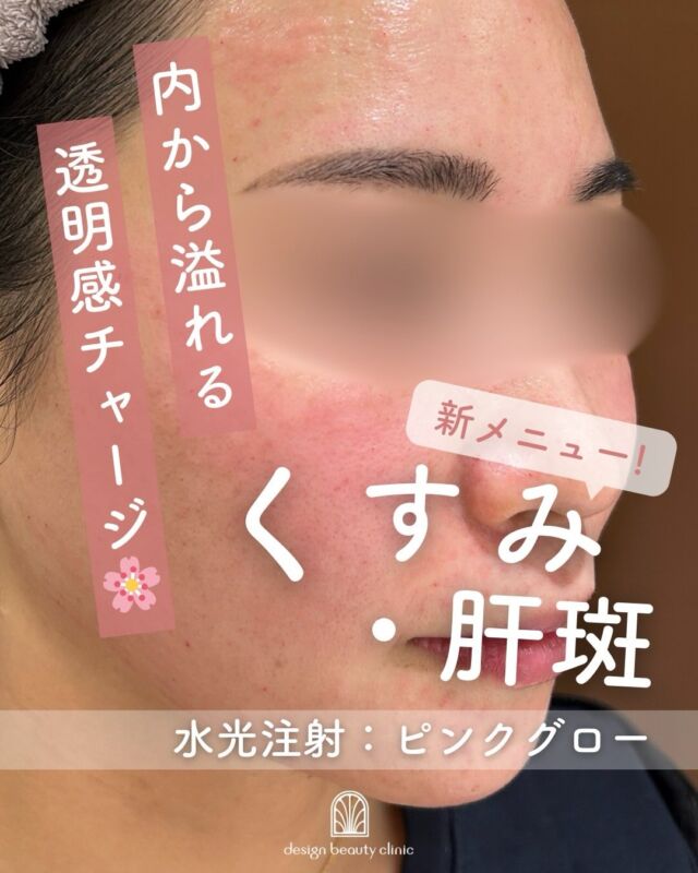 🩷
新メニュー
🌸水光注射ピンクグロー症例🌸

【施術直後】のお写真です📸

ピンクグローは、
✨くすみ
✨色素沈着
✨肝斑
など、肌トーンのお悩みにアプローチできる待望の美白水光注射💉💗

施術直後は、注入による赤みやポコポコとした凹凸が見られることがありますが、
多くの方は数日でなじみ、自然に落ち着いていきます🌿
また、まれに数日後に赤みやほてりを感じる場合もありますが、
こちらも一時的な反応であることがほとんどです。

うるおいを与えながら、
透明感のある明るい『内側から輝くようなピンク肌』へ導きます✨

お肌のお悩みやご不安な点があれば、
お気軽にご相談ください🫶

💖ピンクグロー（水光注射ハイコックス）

初回　26,000円(税込）
通常　36,000円(税込）
3回コース　78,000円(税込）

是非お試しくださいませ

⚠️DMでのお問い合わせはお受けしておりません
お問い合わせは、クリニックへ直接お電話をお願いいたします🌱

————————————

ACCESS：大阪府大阪市北区茶屋町15-8
茶屋町ビル2階
TEL：06-6743-4652
営業時間：10時〜19時

#美容皮膚科 #美容外科 #美容クリニック #designbeautyclinic #デザインビューティークリニック