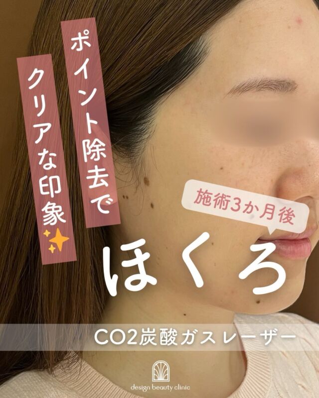 📸 
症例紹介｜施術前 → 3か月後

こちらはCO2ガスレーザーによる除去治療の症例です✨
施術前と、3か月後の経過を比較しています📷

CO2ガスレーザーは、
気になる部分をピンポイントでケアでき、
周囲の皮膚へのダメージを抑えやすいのが特徴です🌿

施術後は、赤みやかさぶたが出ることがありますが、
3〜6か月ほどかけて少しずつ状態が安定していきます🕊️

この期間は特に
・強い摩擦は控える🙅‍♀️
・無意識に触らない✋
・紫外線対策をしっかり☀️

を意識していただくことで、
よりきれいな仕上がりにつながります✨

小さな変化でも、
素顔の印象がすっきり整ったと感じる方が多い施術です😊

※経過や仕上がりには個人差があります
※医師の診察のもと適応を判断しています🩺

気になることがあれば、
いつでもお気軽にご相談ください🤍

～CO2ﾚｰｻﾞｰってなに？～
もともと皮膚には水分が多く含まれており、CO2レーザーを照射することで細胞内の水分が
反応し、熱エネルギーを発生させます。
この熱エネルギーが水分を瞬間的に蒸散することで皮膚が削られ、ホクロが除去されます。
さらに、レーザーを照射した部位周辺の血管は熱凝固作用で瞬時に固まるため、出血の心配はほとんどありません。
また、CO2レーザーの蒸散作用は皮膚の表面のみで、深い層まで届かないので除去後の創傷治癒も比較的早いというのが特徴です。
CO2ﾚｰｻﾞｰの注意点として、ホクロの大きさやメラニンの深さによって1度の施術で取り切れない可能性あります。
その場合の再施術は、前回の施術から3カ月以上空ける必要有り、一時的に患部がへこんだり、傷跡が残る場合もあります。
しっかりとテープ保護を行ってください。

☆3㎜以下：5,500円 / 個
☆8㎜以下：11,000円 / 個
☆茶テープ1巻(保護用)：700円
☆軟膏1本：700円
・カウンセリング＋施術時間：約１時間
・施術中の痛み：局所麻酔の際に軽度の痛み有り
　（※個人差あり）
・ダウンタイム：２週間程度テープ保護必要
・施術後のメイク：患部を避けて当日からOK

⚠️DMでのお問い合わせはお受けしておりません
お問い合わせは、クリニックへ直接お電話をお願いいたします🌱

————————————

ACCESS：大阪府大阪市北区茶屋町15-8
茶屋町ビル2階
TEL：06-6743-4652
営業時間：10時〜17時
(最終受付時間：16時)
お問合せ受付時間：10時〜19時

#美容皮膚科 #美容外科 #美容クリニック #ほくろ取り #co2炭酸ガスレーザー 黒子 ホクロ除去