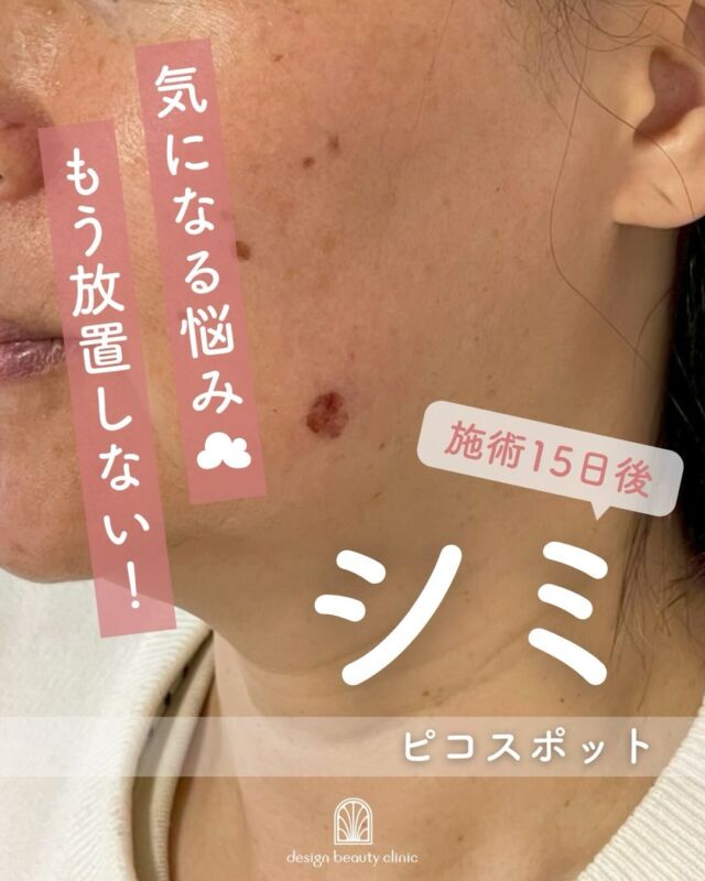 🌷 ピコスポット治療 経過症例のご紹介 🌷

こちらは
施術前 → 施術直後 → 翌日 → 5日後 → 15日後
と、経過を追って撮影した症例写真です📷✨

💡 施術直後〜数日間
照射部位に
🔸 赤み
🔸 ヒリヒリ感
が出ることがあります🌿
また、反応したシミが一時的に濃く見えることもありますが、
これはお肌がしっかり反応している自然な経過です😊

🍃 数日後〜1・2週間
照射した部分は薄いかさぶたになり、
無理に剥がさなくても
1〜2週間ほどで自然に剥がれていきます✨

🌼 1週間〜1ヶ月頃
かさぶたが取れたあとは
ほんのりピンク色の新しいお肌に🩷
少しずつ周りのお肌となじんでいきます🌈

🌸 1ヶ月以降
一時的に
炎症後色素沈着が出る場合もありますが、
多くは3〜6ヶ月かけてゆっくり改善していきます🌿✨

お肌の変化には個人差がありますが、
経過を知っていただくことで
安心して治療を受けていただけたら嬉しいです🕊️💖

気になることやご不安な点があれば、
いつでもお気軽にご相談くださいね☺️✨

☆3㎝×5㎝の範囲内：25000円
※麻酔代＋軟膏代込み
☆1㎜（最大10㎜まで）：1100円
例：1㎝の場合は11000円
※麻酔代別途3000円
※軟膏代別途700円

・カウンセリング＋施術時間：約１時間(麻酔希望の場合+30分)
・施術中の痛み：麻酔ｸﾘｰﾑ使用で痛み軽減（※個人差あり）。麻酔無しも可。
・ダウンタイム：薄いかさぶたになり１～2週間かけて自然に剥がれます。紫外線を避けて過ごす必要有り。
・施術後のメイク：翌日からOK。患部の摩擦はNG。
・洗顔：翌日からOK。

-———————————

ACCESS：大阪府大阪市北区茶屋町15-8
茶屋町ビル2階
TEL：06-6743-4652
営業時間：10時〜17時
(最終受付時間：16時)
お問合せ受付時間：10時〜19時

#美容皮膚科 #美容外科 #美容クリニック #ピコスポット #シミ治療 qスイッチルビーレーザー シミ