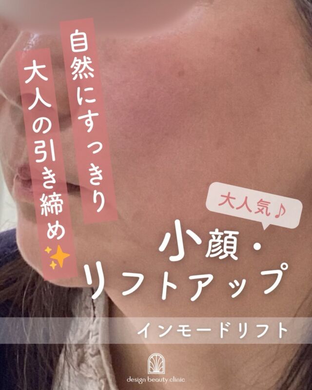 📸
【インモードリフト 7回目の症例です✨】

こちらはインモードリフトを7回受けていただいた患者様のお写真です📷

回数を重ねるごとに、少しずつお顔全体が引き締まり…
フェイスラインがすっきりと整ってきました🌿✨

さらに、口横のもたつきやほうれい線もやわらぎ、
横顔の印象までぐっとシャープに☺️💕

インモードリフトは、高周波エネルギーを使って
脂肪へアプローチしながら、同時にコラーゲン生成を促す施術です✨
引き締めとハリ感アップを同時に目指せるのが特徴です🌸

✔ フェイスラインのもたつきが気になる方
✔ 口横・ほうれい線をすっきりさせたい方
✔ 切らずにリフトアップしたい方
✔ ダウンタイムをできるだけ抑えたい方

このような方におすすめです😊

「なんとなく下がってきたかも…」
そんなお悩みに、自然な変化でやさしく応えてくれる施術です✨

気になる方はぜひお気軽にご相談くださいね🌷

※お写真はご本人様の同意を得て掲載しております
※効果には個人差があります

【料金案内】
☆インモードリフト（フォーマ＋ミニFXセット）初回：25,000円
☆通常：38,000円
☆3回コース：75,000円

☆フォーマ（両頬）初回：12,800円／通常：20,000円／3回：38,400円
☆ミニFX（両頬下またはアゴ下）初回：12,800円／通常：20,000円／3回：38,400円

・カウンセリング＋施術時間：メニューにより異なります
・施術中の痛み：個人差がありますが、痛みはほとんどなく、熱をじんわり感じる程度
・ダウンタイム：数日から1週間程度、赤み・腫れ・内出血が出る場合あり
・施術後のメイク：当日からOK
・リスク、副作用：内出血・腫れ・熱感・吸引性皮下出血・熱傷など（個人差あり）

⚠️DMでのお問い合わせはお受けしておりません。
お問い合わせは、クリニックへ直接お電話をお願いいたします🌱

————————————

ACCESS：大阪府大阪市北区茶屋町15-8
茶屋町ビル2階
TEL：06-6743-4652
営業時間：10時〜17時（最終受付16時）
お問合せ受付時間：10時〜19時

#インモードリフト #フォーマ #ミニFX #リフトアップ #たるみケア 小顔ケア 韓国 美容皮膚科 デザインビューティークリニック