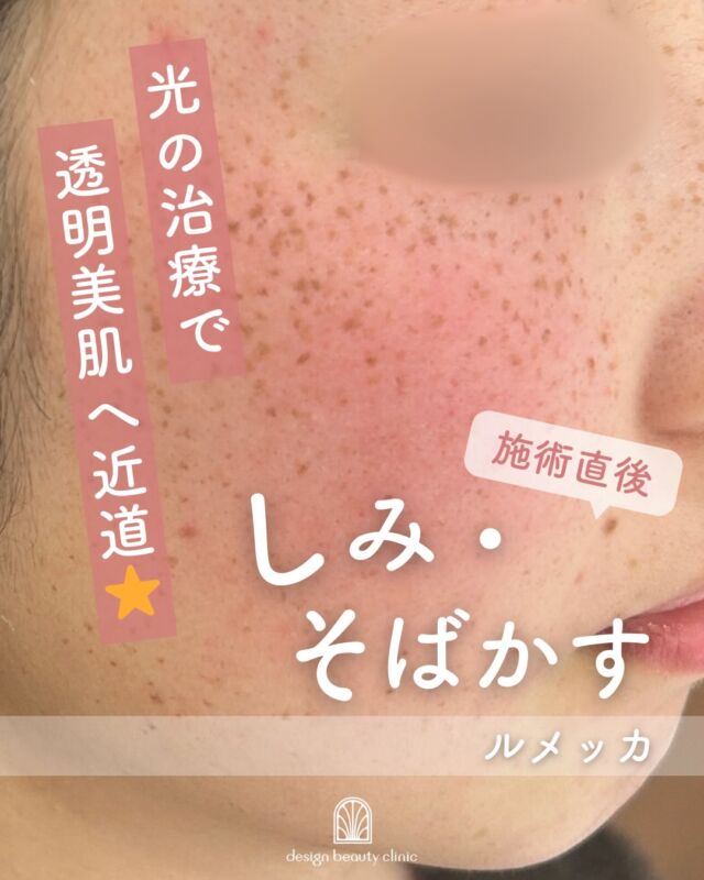 🌿✨
【施術直後のお写真です】

こちらはルメッカ施術直後の症例写真です。

気になる部分にしっかり反応しているため、
一時的に色が濃くなって見える状態になります。

これは光がメラニンに反応しているサイン。
数日かけて少しずつ浮き上がり、
自然と薄くなっていきますのでご安心くださいね💗

🕊️ ダウンタイムについて
・施術直後は赤みやほてりが出ることがあります
・反応した部分が一時的に濃くなります
・数日〜1週間ほどで落ち着いていきます
（※個人差がございます）

メイクは翌日から可能です✨
大切なのはしっかり保湿と紫外線対策です☀️

🌸 このような方におすすめです
・お顔全体のくすみが気になる方
・細かな色ムラを整えたい方
・透明感をアップさせたい方
・ダウンタイムが比較的軽い治療をご希望の方

【ルメッカ 料金】
・初回　9,800円（税込）
・通常　15,800円（税込）
・3回コース　29,400円（税込）

⚠️DMでのお問い合わせはお受けしておりません
お問い合わせは、クリニックへ直接お電話をお願いいたします🌱

————————————

ACCESS：大阪府大阪市北区茶屋町15-8
茶屋町ビル2階
TEL：06-6743-4652
営業時間：10時〜17時
(最終受付時間：16時)
お問合せ受付時間：10時〜19時

#美容皮膚科 #美容外科 #美容クリニック#ルメッカ