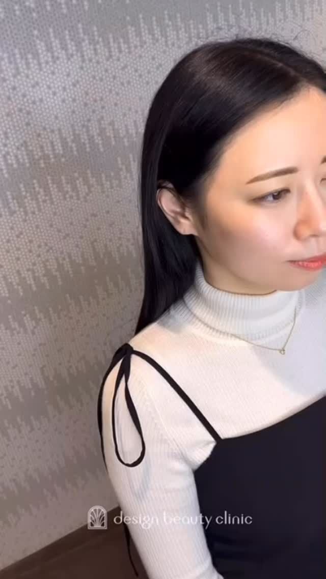 .
【左右差が気になる眉のお悩み🪞✨】

「左右差があって、うまく描けない」
「毎日の眉メイクが大変」
そんなお悩みでご来院くださった方🌿

当院ではデザインの時間をしっかりとっているので
仕上がりを確認しながら微調整ができるのも安心ポイント🤍
左右バランスが整うことで、
毎朝のメイクがぐっとラクになります🎀

理想の眉に近づけるよう、
一人ひとりに合わせて丁寧にサポートします🫧💐

➤施術名：アートメイク眉毛　1回33,000円（税込）
➤施術の説明：皮膚の浅い層を専用針で傷をつけて色素を入れることにより、皮膚を着色する施術です。
➤リスク・副作用：炎症症状(発赤・腫脹・熱感・疼痛)、内出血、痒み、アレルギー反応、感染等。

⚠️DMでのお問い合わせはお受けしておりません
お問い合わせは、クリニックへ直接お電話をお願いいたします🌱

････････････････････････････････････････

■医療機関名
デザイン ビューティー クリニック

■ご予約方法
•WEB／LINE（プロフィールからリンクできます）
•電話

■電話番号（問い合わせ・予約）
メニューによって電話番号が異なります。

🌿アートメイク（大阪）
　06-6616-8095

🌿美容皮膚科メニュー（大阪）
　06-6743-4652

🌿アートメイク（東京）
　03-6263-2519

■店舗紹介
アートメイクは下記の4院どこでもお受けいただけます。

🎀梅田エリアで通いやすい方はこちら🎀
🏥梅田本院
〒530-0013 大阪府大阪市北区茶屋町15-8
茶屋町ビル2階

営業時間：10:00～19:00
定休日：不定休
診療メニュー：美容皮膚科 / アートメイク

🏥アートメイク梅田院
〒530-0014 大阪府大阪市北区鶴野町2-1
梅田タナダビル１階

営業時間：10:00～19:00
定休日：不定休
診療メニュー： アートメイク

🎀 心斎橋・難波(なんば)エリアで通いやすい方はこちら 🎀
🏥アートメイク心斎橋院
〒542-0083 大阪市中央区東心斎橋1-20-14
心斎橋エルナ岩崎ビル5階

営業時間：10:00～19:00
定休日：不定休
診療メニュー： アートメイク

🎀 ついに東京エリアに開院！🎀
🏥アートメイク東京銀座院
〒104-0061 東京都中央区銀座1丁目28-16
SUGIURA GINZA 7階

営業時間：10:00～19:00
定休日：不定休
診療メニュー： アートメイク

････････････････････････････････････････

#アートメイク #アートメイク眉 #アートメイクリップ #アートメイク大阪 #アートメイク東京