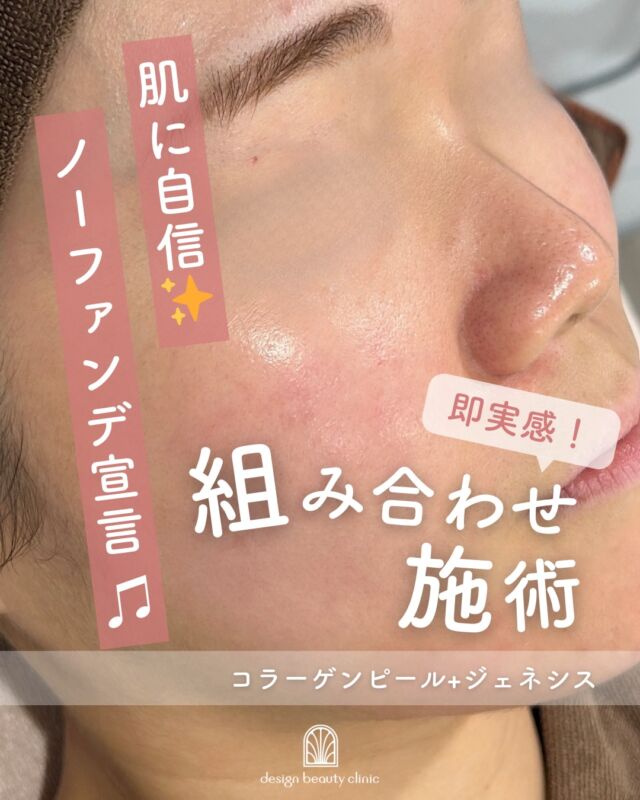 .
【医療美容で叶える、根拠のある美肌治療🩺✨】

当院で人気の
「コラーゲンピール」×「ジェネシス」の組み合わせ治療についてご紹介いたします。

🔹コラーゲンピール
高濃度TCA（トリクロロ酢酸）を主成分とした薬剤を使用し、
肌の深部にアプローチ。
コラーゲンの生成を促し、ハリ・弾力を高めます。

✔ 小じわ
✔ ハリ不足
✔ 肌のたるみが気になる方に

・施術中の痛み：ほとんどなし
・ダウンタイム：赤みや乾燥、痒み等の肌荒れが生じる場合あり
・施術後のメイク：当日からOK
・効果：赤ら顔、ハリツヤ、目元の小じわ、肌質改善

●価格（全顔）
初回9,800円
通常15,800円
平日3回コース　29,400円
全日3回コース　39,400円
※全て税込価格

🔹ジェネシス
肌表面にやさしく熱エネルギーを届け、
毛穴の引き締め・赤みの改善・キメの均一化を目指します。

✔ 毛穴の開き
✔ 赤ら顔
✔ くすみが気になる方に

・カウンセリング＋施術時間： 45分～60分
・施術中の痛み：ほとんどなし
・ダウンタイム： 赤みや熱感、痒み等の肌荒れが生じる場合あり
・施術後のメイク：当日からOK
・効果：赤ら顔、ハリツヤ、ニキビ痕の赤み、ニキビ痕の色素沈着、肌のキメなどの肌質改善

●価格（全顔）
初回3000shot：7,800円
通常3000shot：10,800円
初回6000shot：13,600円
通常6000shot：18,800円

この2つを組み合わせることで、

✨ 内側からのハリ感アップ
✨ 表面のなめらかさ・透明感向上
✨ ダウンタイムがほとんどない治療

が期待できます。

「美容医療が初めてで不安…」という方も、
医師の診察のもと、肌状態に合わせてご提案いたしますのでご安心ください。

まずはカウンセリングからお気軽にご相談ください🕊️

⚠️DMでのお問い合わせはお受けしておりません
お問い合わせは、クリニックへ直接お電話をお願いいたします🌱

-———————————

ACCESS：大阪府大阪市北区茶屋町15-8
茶屋町ビル2階
TEL：06-6743-4652
営業時間：10時〜17時
(最終受付時間：16時)
お問合せ受付時間：10時〜19時

#美容皮膚科 #美容外科 #美容クリニック #美肌 #肌質改善