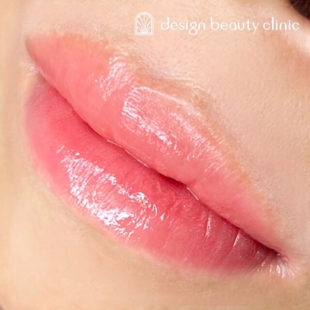 .
■お悩み・ご希望：
血色が悪く見えることがお悩みの方😖
鮮やかに、リップを塗るときに影響がないように仕上げました⤴️💖

■施術内容：
リップアートメイク

お写真ご協力ありがとうございました☺️

➤施術名：アートメイクリップ　1回44,000円（税込）
➤施術の説明：皮膚の浅い層を専用針で傷をつけて色素を入れることにより、皮膚を着色する施術です。
➤リスク・副作用：炎症症状(発赤・腫脹・熱感・疼痛)、内出血、痒み、アレルギー反応、感染等。

⚠️DMでのお問い合わせはお受けしておりません
お問い合わせは、クリニックへ直接お電話をお願いいたします🌱

････････････････････････････････････････

■医療機関名
デザイン ビューティー クリニック

■ご予約方法
•WEB／LINE（プロフィールからリンクできます）
•電話

■電話番号（問い合わせ・予約）
メニューによって電話番号が異なります。

🌿アートメイク（大阪）
　06-6616-8095

🌿美容皮膚科メニュー（大阪）
　06-6743-4652

🌿アートメイク（東京）
　03-6263-2519

■店舗紹介
アートメイクは下記の4院どこでもお受けいただけます。

🎀梅田エリアで通いやすい方はこちら🎀
🏥梅田本院
〒530-0013 大阪府大阪市北区茶屋町15-8
茶屋町ビル2階

営業時間：10:00～19:00
定休日：不定休
診療メニュー：美容皮膚科 / アートメイク

🏥アートメイク梅田院
〒530-0014 大阪府大阪市北区鶴野町2-1
梅田タナダビル１階

営業時間：10:00～19:00
定休日：不定休
診療メニュー： アートメイク

🎀 心斎橋・難波(なんば)エリアで通いやすい方はこちら 🎀
🏥アートメイク心斎橋院
〒542-0083 大阪市中央区東心斎橋1-20-14
心斎橋エルナ岩崎ビル5階

営業時間：10:00～19:00
定休日：不定休
診療メニュー： アートメイク

🎀 ついに東京エリアに開院！🎀
🏥アートメイク東京銀座院
〒104-0061 東京都中央区銀座1丁目28-16
SUGIURA GINZA 7階

営業時間：10:00～19:00
定休日：不定休
診療メニュー： アートメイク

････････････････････････････････････････

#アートメイク #美容クリニック #アートメイク眉 #アートメイクリップ #眉アート