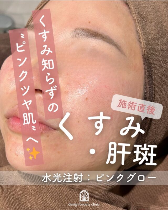 .
💉✨話題の“ピンクグロー水光注射”で透明感あふれるツヤ肌へ✨💉

乾燥・くすみだけでなく、しみ・そばかすが気になる方にもおすすめ💗
ピンクグローは、美白・保湿・エイジングケア成分を贅沢に配合したスキンブースター🌸

こちらは【施術直後】のお写真です📷

水光注射でお肌の奥までしっかり届けることで…
✔ 内側から発光するようなツヤ肌に✨
✔ 透明感アップ＆トーンアップ💎
✔ しみ・そばかすのケアにも◎
✔ 小ジワ・毛穴の目立ち改善

施術直後からうるおいを実感しやすく、回数を重ねるごとにより均一でなめらかな肌へ💕
施術直後は、注入による赤みやポコポコとした凹凸が見られることがありますが、
多くの方は数日でなじみ、自然に落ち着いていきます🌿
また、まれに数日後に赤みやほてりを感じる場合もありますが、
こちらも一時的な反応であることがほとんどです。

【ダウンタイムについて】
・赤みや膨隆疹は当日から2〜3日中に落ち着くことがほとんどです。
・点状出血は1〜2週間残る場合もあります。
・洗顔、スキンケア、メイクは翌日から可能（※詳しくはカウンセリングでお伝えします。）

気になる方はぜひお気軽にご相談ください💖

💖ピンクグロー（水光注射ハイコックス）

初回　26,000円(税込）
通常　36,000円(税込）
3回コース　78,000円(税込）

是非お試しくださいませ

⚠️DMでのお問い合わせはお受けしておりません
お問い合わせは、クリニックへ直接お電話をお願いいたします🌱

————————————

ACCESS：大阪府大阪市北区茶屋町15-8
茶屋町ビル2階
TEL：06-6743-4652
営業時間：10時〜19時

#美容皮膚科 #美容外科 #美容クリニック #designbeautyclinic #デザインビューティークリニック