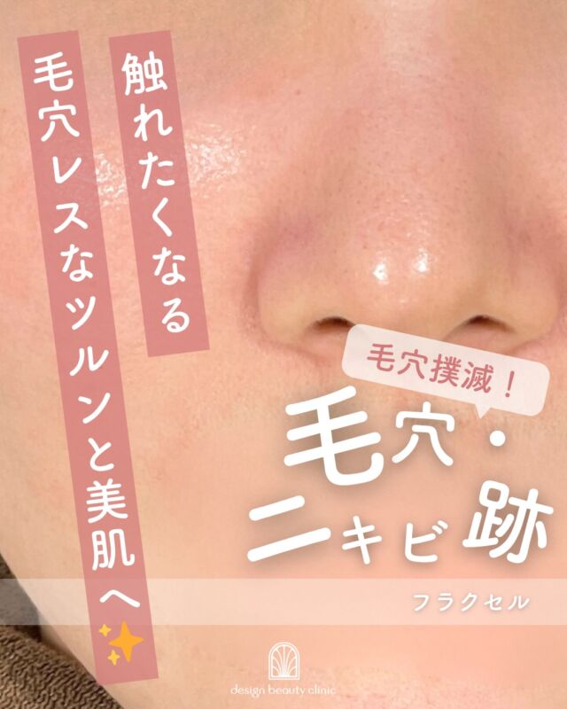 .
💉✨毛穴・ニキビ跡にアプローチ“CO2フラクセル”でなめらかな美肌へ✨💉

開いた毛穴やクレーター状のニキビ跡にお悩みの方へ💗
CO2フラクセルは、肌に微細なレーザーを点状に照射し、お肌の再生力を高める治療です🌿

こちらは【施術後経過】のお写真です📷

レーザーでお肌の奥にアプローチすることで…
✔ 毛穴の開きを引き締め✨
✔ ニキビ跡の凹凸をなめらかに改善
✔ コラーゲン生成を促進しハリ感アップ💎
✔ キメの整ったつるんとした肌へ

1回でも変化を感じる方はいらっしゃいますが、回数を重ねることでより効果を実感しやすく、なめらかで均一なお肌へ導きます💕

施術後は赤みやヒリつき、ざらつき感が出ることがありますが、数日〜1週間程度で徐々に落ち着いていきます🌿
また、細かいかさぶたのような反応が出る場合もありますが、無理に剥がさず自然に取れるのをお待ちください。

【ダウンタイムについて】
・赤み、ヒリつき：数日〜1週間程度
・ざらつき、かさぶた：数日〜1週間程度
・洗顔、スキンケア：当日から可能（※刺激の少ないもの推奨）
・メイク：翌日から可能

お肌状態に合わせて施術回数や出力を調整いたしますので、美容医療が初めての方も安心してご相談ください✨
気になる方はぜひお気軽にお問い合わせください💖

【フラクセル 料金】
（鼻または頬）
・初回　7,900円（税込）
・通常　12,750円（税込）
・3回コース(7,900円/1回)　23,700円（税込）
・10回コース(7,110円/1回)　71,100円（税込）

（全顔）
・初回　15,800円（税込）
・通常　25,500円（税込）
・3回コース(15,800円/1回)　47,400円（税込）
・10回コース(14,220円/1回)　142,200円（税込）
（※別途麻酔代 3,000円）

⚠️DMでのお問い合わせはお受けしておりません
お問い合わせは、クリニックへ直接お電話をお願いいたします🌱

————————————

ACCESS：大阪府大阪市北区茶屋町15-8
茶屋町ビル2階
TEL：06-6743-4652
営業時間：10時〜17時
(最終受付時間：16時)
お問合せ受付時間：10時〜19時

#美容皮膚科 #美容外科 #美容クリニック #フラクセル
