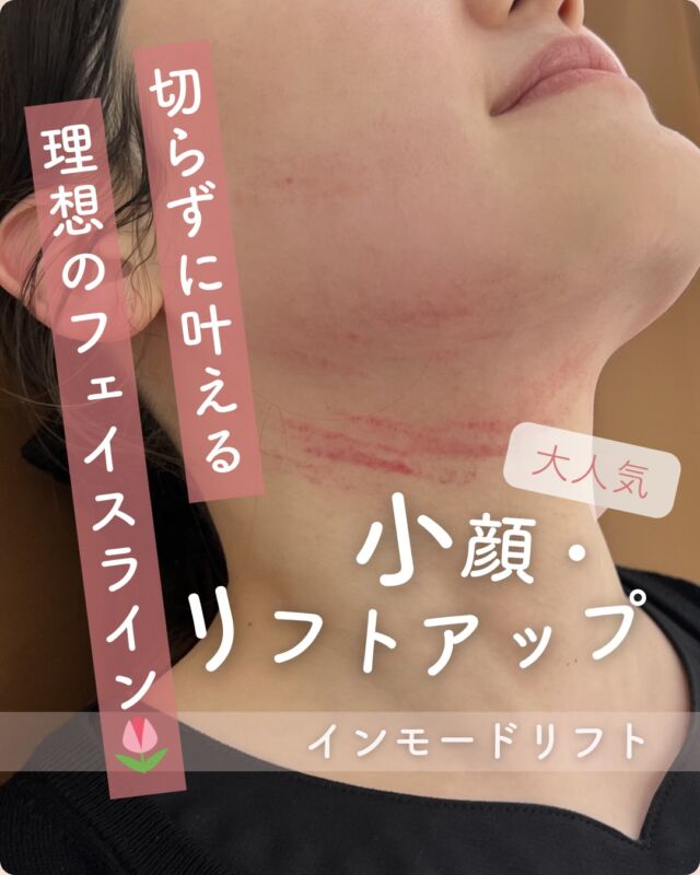 .
💫たるみ・もたつきが気になる方へ💫
話題の【インモードリフト】で、引き締まった小顔へ✨

インモードリフトとは…
高周波（RF）を使って、お肌の内側からじんわり温めることで
✔️ たるみ改善
✔️ フェイスラインの引き締め
✔️ ハリ・弾力アップ
が期待できる施術です😊

施術後はスッキリしたフェイスラインを実感される方も多く、回数を重ねることでさらに効果アップが期待できます💕

💎4月限定「小顔キャンペーン」開催中！💎
⚫︎インモードリフト(フォーマ両頬＋ミニFXアゴ下)
「またやってほしい」にお応えして！
通常38,000円 → 4月限定19,800円（税込）
※4月の全日対象/1回限り

⚫︎ハイフ(ウルトラセルZi)
コチラも再び！特別価格
春の小顔メンテナンス
【300shot】通常34,800円 → 4月限定24,800円（税込）
※4月の全日対象/1回限り

💎大特価キャンペーン💎
⚫︎ピンクグロー（5cc）+SRSパック+麻酔
新導入の水光注射！
通常 77,200円→4月限定 24,800円
※4月の全日対象/1回限り

💎新生活の今の時期におすすめ💎
⚫︎ハイドラジェントル
毛穴ごっそり洗浄
通常 13,800円→初回限定 9,800円
※初めての方限定/1回限り

施術選びに迷われる方は、
お気軽にスタッフまでご相談ください💬

キャンペーン中はご予約が埋まりやすいのでお早めに🕊️

⚠️DMでのお問い合わせはお受けしておりません。
お問い合わせは、クリニックへ直接お電話をお願いいたします🌱

————————————

ACCESS：大阪府大阪市北区茶屋町15-8
茶屋町ビル2階
TEL：06-6743-4652
営業時間：10時〜17時（最終受付16時）
お問合せ受付時間：10時〜19時

#美容皮膚科 #美容クリニック #デザインビューティークリニック #インモードリフト #ハイフ