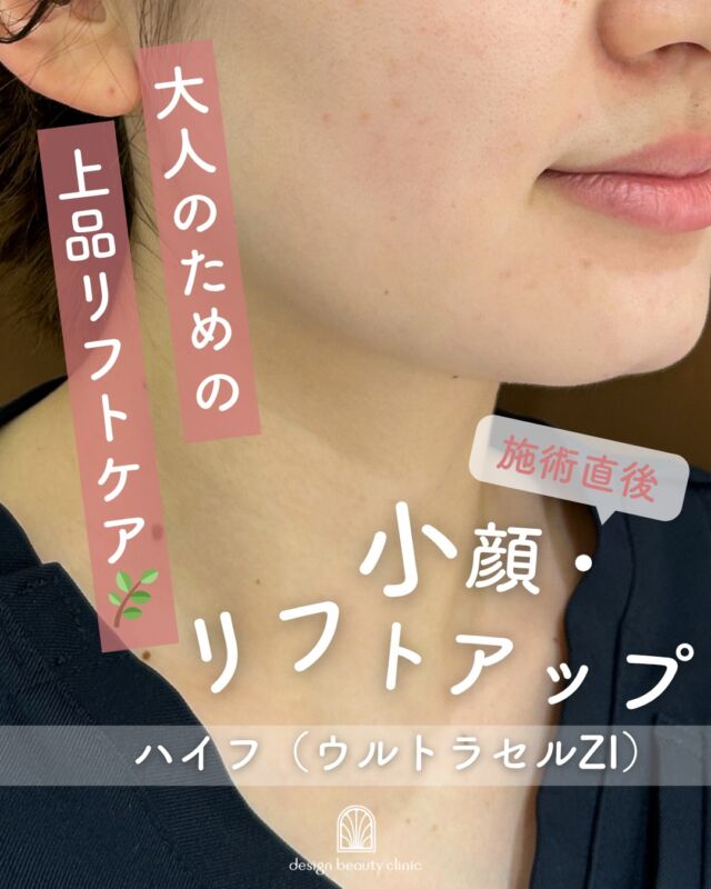 .

🌸ハイフ4月のお得なキャンペーン中🌸
300shot 通常 ¥34,800→全員¥24,800（税込）
平日/土日祝問わず、全てのお日にちで予約OK🙆‍♀️

「最近、フェイスラインがぼやけてきたかも…」
そんなお悩みはありませんか？

こちらは【施術直後】のお写真です📷

ハイフは、超音波の力で肌の奥にアプローチし、
内側からキュッと引き締めるリフトケアです✨

✔ フェイスラインのもたつき
✔ 頬や口元のたるみ
✔ 二重あごが気になる方に

幅広い年代の方に選ばれています🌿

切らずに受けられて、ダウンタイムもほとんどないため、
初めての美容施術にもおすすめ◎

施術直後のすっきり感に加え、
時間の経過とともにさらに引き締まりを実感✨

“無理なく、自然に整える”
そんなリフトケアを始めてみませんか？

☆300shot：(初回)24,800円/(通常)34,800円
☆400shot：(初回)39,800円/(通常)49,800円
☆500shot：(初回)49,800円/(通常)59,800円
☆リニア100shot：11,000円

・カウンセリング＋施術時間： 1時間
・施術中の痛み：骨に鈍痛の様な痛みが伴う場合あり
・ダウンタイム：2、３日から1週間前後、筋肉痛のような痛みが伴う場合あり
・施術後のメイク：当日からOK
・効果：たるみ、ほうれい線、しわ、二重顎、リフトアップ、小顔

———————————

ACCESS：大阪府大阪市北区茶屋町15-8
茶屋町ビル2階
TEL：06-6743-4652
営業時間：10時〜17時
(最終受付時間：16時)
お問合せ受付時間：10時〜19時

⚠️DMでのお問い合わせはお受けしておりません
お問い合わせは、クリニックへ直接お電話をお願いいたします🌱