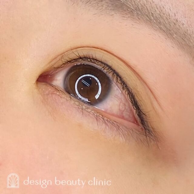 ■お悩み・ご希望：
まつ毛の隙間が気になるので、隙間を埋めてナチュラルに目をぱっちりさせたいです🌟とのお悩み、ご希望でした🌷

■施術内容：
アイラインアートメイク

お写真ご協力ありがとうございました☺️

➤施術名：アートメイクアイライン　1回22,000円（税込）
➤施術の説明：皮膚の浅い層を専用針で傷をつけて色素を入れることにより、皮膚を着色する施術です。
➤リスク・副作用：炎症症状(発赤・腫脹・熱感・疼痛)、内出血、痒み、アレルギー反応、感染等。

⚠️DMでのお問い合わせはお受けしておりません
お問い合わせは、クリニックへ直接お電話をお願いいたします🌱

････････････････････････････････････････

■医療機関名
デザイン ビューティー クリニック

■ご予約方法
•WEB／LINE（プロフィールからリンクできます）
•電話

■電話番号（問い合わせ・予約）
メニューによって電話番号が異なります。

🌿アートメイク（大阪）
　06-6616-8095

🌿美容皮膚科メニュー（大阪）
　06-6743-4652

🌿アートメイク（東京）
　03-6263-2519

■店舗紹介
アートメイクは下記の4院どこでもお受けいただけます。

🎀梅田エリアで通いやすい方はこちら🎀
🏥梅田本院
〒530-0013 大阪府大阪市北区茶屋町15-8
茶屋町ビル2階

営業時間：10:00～19:00
定休日：不定休
診療メニュー：美容皮膚科 / アートメイク

🏥アートメイク梅田院
〒530-0014 大阪府大阪市北区鶴野町2-1
梅田タナダビル１階

営業時間：10:00～19:00
定休日：不定休
診療メニュー： アートメイク

🎀 心斎橋・難波(なんば)エリアで通いやすい方はこちら 🎀
🏥アートメイク心斎橋院
〒542-0083 大阪市中央区東心斎橋1-20-14
心斎橋エルナ岩崎ビル5階

営業時間：10:00～19:00
定休日：不定休
診療メニュー： アートメイク

🎀 ついに東京エリアに開院！🎀
🏥アートメイク東京銀座院
〒104-0061 東京都中央区銀座1丁目28-16
SUGIURA GINZA 7階

営業時間：10:00～19:00
定休日：不定休
診療メニュー： アートメイク

････････････････････････････････････････
#アートメイク #アートメイク眉 #アートメイクリップ #アートメイク大阪 #アートメイク東京