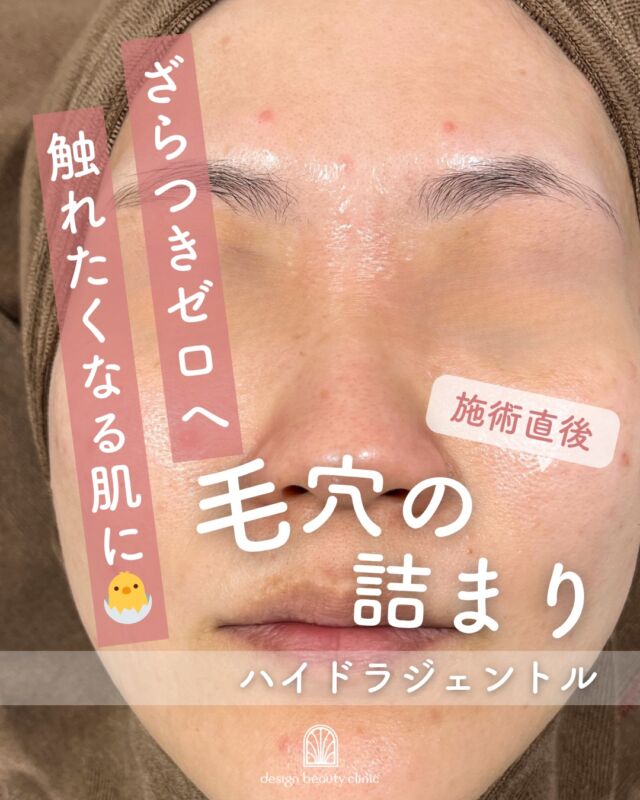 .
【ハイドラジェントルってなに？💧】

毛穴の黒ずみやざらつき、気になっていませんか？😢
そんな方におすすめなのが「ハイドラジェントル」✨

症例は施術直後のお写真です📷

特殊な水流のチカラと2種類のピーリング剤を使用し、毛穴の汚れや古い角質をやさしくオフするウォーターピーリングマシンです💎
水溶性のピーリング剤(AHA)でお肌の汚れや古い角質を除去した後、油溶性のピーリング剤(BHA)で毛穴の黒ずみや角栓を除去していきます。
このピーリング剤をお肌に噴射させながら汚れを吸引していくので、お肌に負担をかけずに不要な角質や毛穴詰まりを取り除くことができます🧹
施術後はメイクもしていただけるので気軽に受けていただけます💄

✔ 毛穴の黒ずみが気になる
✔ お肌のざらつきをなめらかにしたい
✔ ダウンタイムの少ない施術がいい

こんな方にぴったり😊

施術後は、つるんとなめらかな透明感のあるお肌へ✨
初めての方でも受けやすい、やさしいケアです💕

【📍追加料金なしでポアレス込み！】
ハイドラジェントルの「ポアレス」とは、
ハイドラジェントル施術の際に鼻などの毛穴部分へ使う角質除去剤（角質軟化剤）で、
毛穴汚れや角栓をより集中的に柔らかくして落としやすくするオプション処置です。

当院では、このポアレスを追加料金なしで通常施術に含めておりますので、
毛穴の黒ずみ・角栓をよりしっかり浮かせて除去しやすくなります

【📍レーザーとの併用がおすすめ！】
毛穴の開き・赤み・ニキビ跡などの根本的な改善を目指す方には
レーザートーニングやフラクショナルレーザーとの併用も効果的です。

男性の方も多くご来院いただいております。
肌の印象を変えたい方、ぜひ一度ご体験ください💆‍♂️

■初回全顔：9,800円
■通常全顔：13,800円

・カウンセリング＋施術時間： 30分
・施術中の痛み：ひりつきを伴う場合あり
・ダウンタイム： 赤みや熱感、痒み等の肌荒れが生じる場合あり
・施術後のメイク：当日からOK
・効果：黒ずみ・ざらつきの改善、肌のトーンアップ、ハリ・艶感アップ

————————————

ACCESS：大阪府大阪市北区茶屋町15-8
茶屋町ビル2階
TEL：06-6743-4652
営業時間：10時〜17時
(最終受付時間：16時)
お問合せ受付時間：10時〜19時

#美容皮膚科 #美容外科 #ハイドラジェントル #美肌治療 #肌ケア
