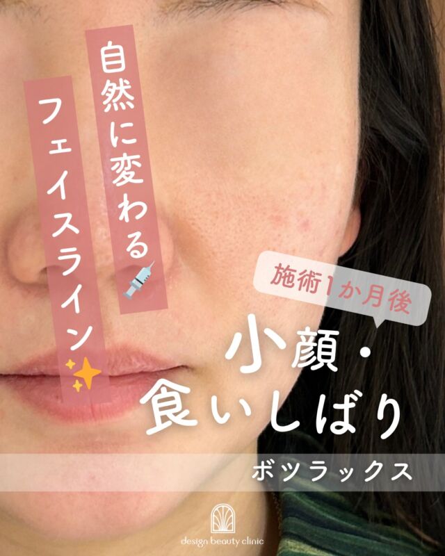 .
「エラ張り、気になっていませんか？🤔」

実はその原因、“筋肉”かもしれません💡
エラボトックスは、発達した筋肉をやさしくゆるめて
フェイスラインをすっきり整える施術です✨

✔ メス不要で気軽に受けられる
✔ ダウンタイムほぼなし🕊️
✔ 自然に小顔印象へ💖

「なんとなく顔が大きく見える…」
「横顔に自信がほしい！」
そんな方におすすめです😊

あなたも“すっきり輪郭”はじめてみませんか？💫
お気軽にご相談ください📩

■ボツラックス
ボツラックス（Botulax）は、韓国のHugel社が製造したA型ボツリヌス毒素を有効成分とする薬剤です。
承認状況：国内未承認
入手経路：PRSS社より入手
国内の承認医薬品などの有無：同一の成分や性能を有する他の国内承認医薬品等はありません
諸外国における安全性等に係る情報：韓国の食品医薬品安全庁（KFDA）

【ボツラックス：エラ】
◾️シングル：10,000円
◾️ダブル：16,000円
◾️トリプル：25,000円
・カウンセリング+施術時間：30分
・施術中の痛み：チクっとした痛みあり
（※個人差あり）
（※表面麻酔希望の場合：追加3,000円）
・ダウンタイム：内出血がでる場合もありますが、徐々に落ち着きます。
ボツラックスは熱に弱い為、薬剤が安定するまでの１週間は血行を促進させるサウナや岩盤浴などは控えてください。
・施術後のメイク：施術部位を避ければ当日から可能
・効果：表情ジワの改善、エラの改善、小顔効果、肩こり改善、多汗症の改善

———————————

ACCESS：大阪府大阪市北区茶屋町15-8
茶屋町ビル2階
TEL：06-6743-4652
営業時間：10時〜17時
(最終受付時間：16時)
お問合せ受付時間：10時〜19時

⚠️DMでのお問い合わせはお受けしておりません
お問い合わせは、クリニックへ直接お電話をお願いいたします🌱

#美容皮膚科 #美容外科 #美容クリニック #designbeautyclinic #デザインビューティークリニック