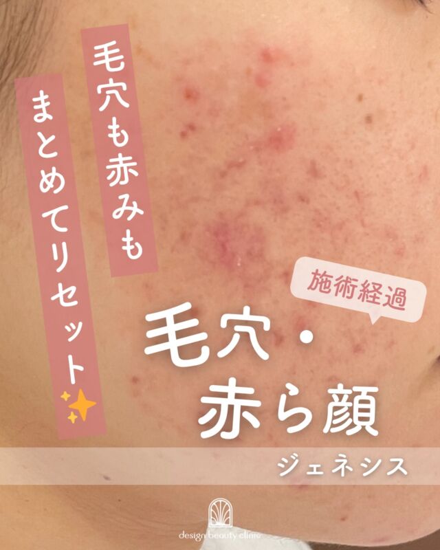 .
【肌を底上げする“やさしいレーザー”ジェネシス✨】

症例は施術前と5回施術後のお写真です📷

✔ 毛穴の開きが気になる
✔ 赤み・ニキビ跡を改善したい
✔ 最近なんとなく肌がくすむ…

そんな方におすすめなのが「ジェネシス」💡

肌から少し離してレーザーを当てることで、
じんわりと温かさを感じながら
コラーゲン生成をサポートします✨

その結果…
・毛穴が引き締まる
・肌にハリとツヤが出る
・赤みやくすみが改善

ダウンタイムほぼなしで、
施術後すぐメイクOKなのも嬉しいポイント◎

「大きく変える」より
“今の肌をもっときれいにする”治療です🌿

はじめての美容医療にもおすすめ💎

・カウンセリング＋施術時間： 45分～60分
・施術中の痛み：ほとんどなし
・ダウンタイム： 赤みや熱感、痒み等の肌荒れが生じる場合あり
・施術後のメイク：当日からOK
・効果：赤ら顔、ハリツヤ、ニキビ痕の赤み、ニキビ痕の色素沈着、肌のキメなどの肌質改善

●価格（全顔）
初回3000shot：7,800円
通常3000shot：10,800円
初回6000shot：13,600円
通常6000shot：18,800円

-———————————

ACCESS：大阪府大阪市北区茶屋町15-8
茶屋町ビル2階
TEL：06-6743-4652
営業時間：10時〜17時
(最終受付時間：16時)
お問合せ受付時間：10時〜19時

#美容皮膚科 #美容外科 #美容クリニック #美肌 #肌質改善