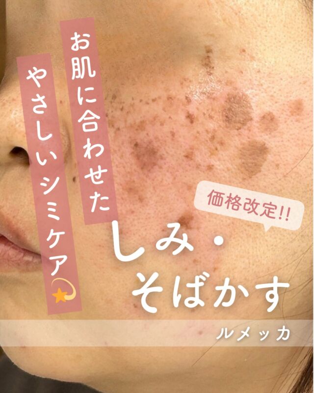 .
✨【しみ取り治療で透明感アップ】✨

「最近、しみが増えた気がする…」
「ファンデで隠しきれない…」
そんなお悩みにおすすめなのが、当院のしみ治療メニューです💎

🔸ルメッカ
IPLの光でシミ・そばかす・赤みを改善✨
肌全体のトーンアップやハリ感アップも期待できます。

🔸ピコスポット
気になる濃いシミをピンポイントで照射⚡
短時間で高い効果を目指せる人気施術です。

🔸トラネキサム酸クリーム
肝斑や色素沈着ケアにおすすめ🫧
毎日のスキンケアに取り入れやすく、施術後のケアにも◎

お一人おひとりのお肌状態に合わせて、
最適な治療をご提案いたします🌿

「すっぴんに自信を持ちたい」
そんな方はぜひご相談ください🤍

⚠️DMでのお問い合わせはお受けしておりません
お問い合わせは、クリニックへ直接お電話をお願いいたします🌱

————————————

ACCESS：大阪府大阪市北区茶屋町15-8
茶屋町ビル2階
TEL：06-6743-4652
営業時間：10時〜17時
(最終受付時間：16時)
お問合せ受付時間：10時〜19時

#美容皮膚科 #美容外科 #美容クリニック#ルメッカ