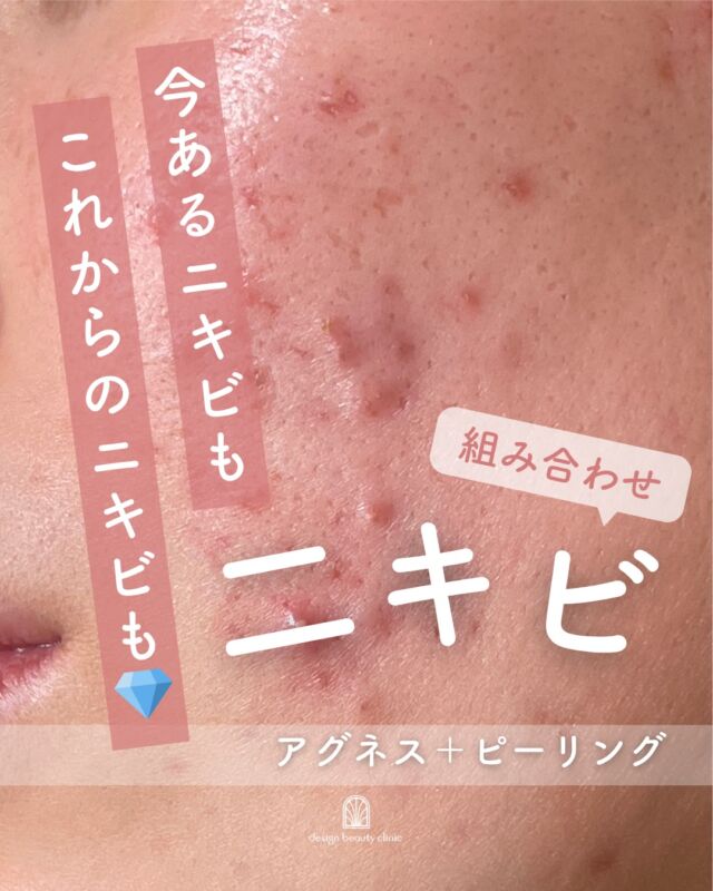 .
繰り返すニキビに、“攻め”と“整える”のWアプローチ✨

当院人気の
💉アグネス
🫧サリチル酸ピーリング
を組み合わせたニキビ治療をご紹介🤍

アグネスでニキビの原因となる皮脂腺へ直接アプローチしながら、
サリチル酸ピーリングで古い角質や毛穴汚れをやさしくケア✨

✔ 繰り返す大人ニキビ
✔ フェイスラインのニキビ
✔ 炎症ニキビ
そんなお悩みにおすすめです💎

「その場しのぎ」ではなく、
ニキビのできにくい肌づくりを目指したい方へ🕊️

お肌状態に合わせて治療回数や組み合わせをご提案いたします✨
ぜひお気軽にご相談ください🤍

【料金案内】
〈アグネス〉
☆全顔初回：39,800円
☆全顔通常：59,800円
☆部分初回：10,800円
☆部分通常：16,500円
☆3回コース：64,800円
※麻酔代別途：3,000円
※汗管腫の施術は上記とは異なる料金設定です

〈サリチル酸ピーリング〉
☆前顔初回：5,500円
☆前顔通常：8,800円
☆3回コース：16,500円

・カウンセリング＋施術時間：約1時間半
・施術中の痛み：表面麻酔を使用します
・ダウンタイム：1週間前後、赤み・腫れ・熱感が生じる場合あり（個人差あり）
・施術後のメイク：術後3日以降から可能
・効果：ニキビ、汗管腫への改善

⚠️DMでのお問い合わせはお受けしておりません。
お問い合わせは、クリニックへ直接お電話をお願いいたします🌱

————————————

ACCESS：大阪府大阪市北区茶屋町15-8
茶屋町ビル2階
TEL：06-6743-4652
営業時間：10時〜17時（最終受付16時）
お問合せ受付時間：10時〜19時

#アグネス #ニキビ治療 #繰り返すニキビ #口周りニキビ #美容皮膚科