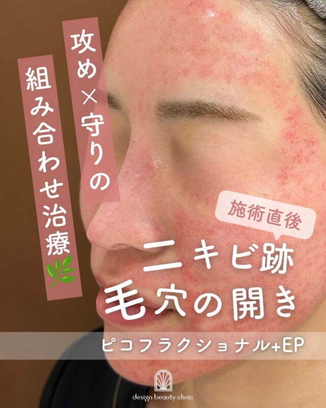 .
✨毛穴・肌質改善を同時にケアしたい方へ✨

「ピコフラクショナル × エレクトロポレーション」の組み合わせ施術は、
お肌を整えながら美容成分をしっかり届ける人気メニューです💎

ピコフラクショナルは、
レーザーでお肌に微細な刺激を与えることで、
毛穴・ニキビ跡・肌の凹凸へアプローチ✨

さらに施術後にエレクトロポレーションを組み合わせることで、
美容成分をお肌の奥まで届け、
乾燥しやすい施術後のお肌をしっかり保湿します🌿

✔ 毛穴が気になる
✔ ニキビ跡をなめらかにしたい
✔ 肌質を整えたい
✔ ハリ・ツヤ感も欲しい

そんな方におすすめです💫

ダウンタイムや痛みが不安な方にも、
お一人おひとりのお肌状態に合わせてご提案いたします🕊️

内側からふっくらなめらかなお肌を目指しましょう✨

【ピクフラクショナル】
全顔
◾️初回：15,800円
◾️通常：25,500円
鼻または頬
◾️初回：7,900円
◾️通常：12,750円
（※別途麻酔 3,000円）

【エレクトロポレーション】
◾️初回：5,500円
◾️通常：6,600円

薬剤追加オプション
◾️ニキビ/美白/エイジング：3,300
◾️ベビースキン：9,800円

⚠️DMでのお問い合わせはお受けしておりません
お問い合わせは、クリニックへ直接お電話をお願いいたします🌱

————————————

ACCESS：大阪府大阪市北区茶屋町15-8
茶屋町ビル2階
TEL：06-6743-4652
営業時間：10時〜17時
(最終受付時間：16時)
お問合せ受付時間：10時〜19時

#美容皮膚科 #美容外科 #ピコフラクショナル #エレクトロポレーション #肌質改善