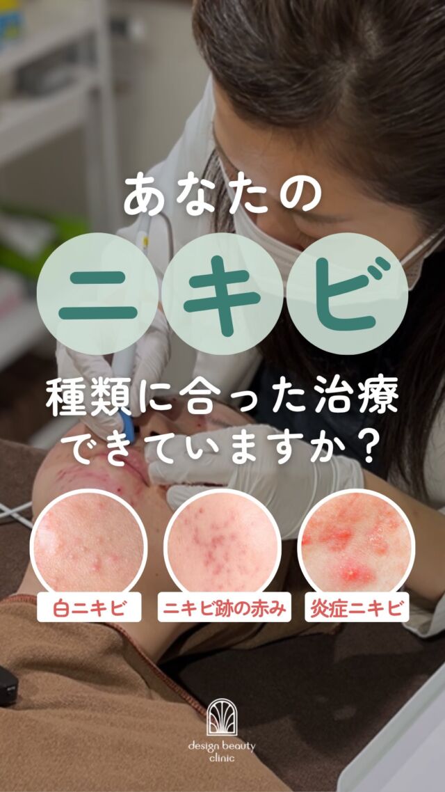 🌿
＼あなたのニキビ、種類に合った治療できていますか？🫧／

ニキビといっても種類によって向いている治療が異なります😌

「ずっと同じケアをしているのに治らない…」という方は、
別の治療方法があるかもしれません👀💭

炎症性ニキビにはアグネス
ニキビの原因の皮脂腺に特殊な針で高周波を流して皮脂腺を焼くことで、ニキビを根本から解決する治療です🍀
「何をやっても治らない」「同じところに繰り返しできる」そんなニキビにも効果的です✨

自分に合った治療がわからないという方にも、無料カウンセリングを実施中！
当院は美容ナースがカウンセリングを行います🌷

🌿アグネス
☆部分（額・片頬・鼻・顎・あご下）
初回：10,800円
通常：16,500円

☆全顔（メルティング含む※）
初回：39,800円
通常：59,800円
3回コース：119,400円（1回あたり39,800円）

※麻酔代別途：3,000円
※汗管腫の施術は上記とは異なる料金設定です

・カウンセリング＋施術時間：約1時間
・施術中の痛み：表面麻酔を使用します
・ダウンタイム：1週間前後、赤み・腫れ・熱感が生じる場合あり（個人差あり）
・施術後のメイク：術後3日以降から可能
・効果：ニキビ、汗管腫への改善

👇動画でご紹介しているその他の施術

🌿サリチル酸ピーリング
☆全顔
初回：5,500円
通常：8,800円
3回コース：16,500円（1回あたり5,500円）

🌿ジェネシス
☆3000shot
初回：7,800円
通常：10,800円

☆6000shot
初回：13,600円
通常：18,800円
3回コース：40,800円（1回あたり13,600円）
10回コース：122,400（1回あたり12,240円）

ご予約はLINE予約・WEB予約・お電話にて受け付けております🌷
カウンセリング無料、美容ナースがあなたのお悩みに寄り添います。

⚠️DMでのお問い合わせはお受けしておりません
お問い合わせは、クリニックへ直接