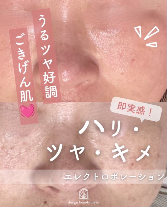 .
✨エレクトロポレーションでワンランク上のスキンケア✨

こちらの症例は10回施術後のお写真です📷

エレクトロポレーションとは、特殊な電気パルスを利用して、お肌に一時的な通り道をつくり、美容成分を角質層のすみずみまで届ける施術です。

普段のスキンケアでは浸透しにくい高分子の美容成分も導入できるため、より効率的な美肌ケアが期待できます✨

🌿こんなお悩みにおすすめ
・乾燥によるカサつき
・肌のハリや弾力の低下
・くすみが気になる
・紫外線ダメージ後のケア
・レーザーやピーリング後の保湿ケア

導入する美容成分によって期待できる効果も異なります💡

施術中の痛みはほとんどなく、ダウンタイムも少ないため、美容医療が初めての方にも人気の施術です😊

【エレクトロポレーション】
◾️初回：5,500円
◾️通常：6,600円

薬剤追加オプション
◾️ニキビ/美白/エイジング：3,300
◾️ベビースキン：9,800円

⚠️DMでのお問い合わせはお受けしておりません
お問い合わせは、クリニックへ直接お電話をお願いいたします🌱

————————————

ACCESS：大阪府大阪市北区茶屋町15-8
茶屋町ビル2階
TEL：06-6743-4652
営業時間：10時〜17時
(最終受付時間：16時)
お問合せ受付時間：10時〜19時

#美容皮膚科 #美容外科 #導入保湿 #エレクトロポレーション #肌質改善